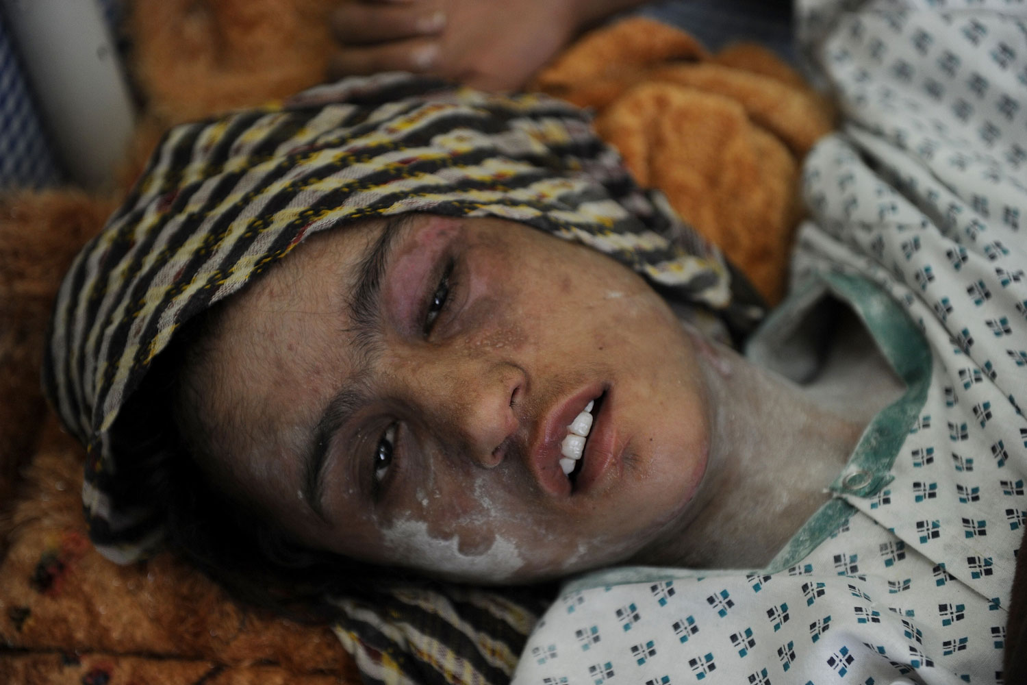 January 12, 2012. Afghan child bride Sahar Gul, 15, lies in a bed as she recovers at the Wazir Akbar Khan hospital in Kabul. Afghan President Hamid Karzai pledged January 12 to take action against the  cowardly  perpetrators of violence against women in the wake of a horrific case of the torture of a child bride.