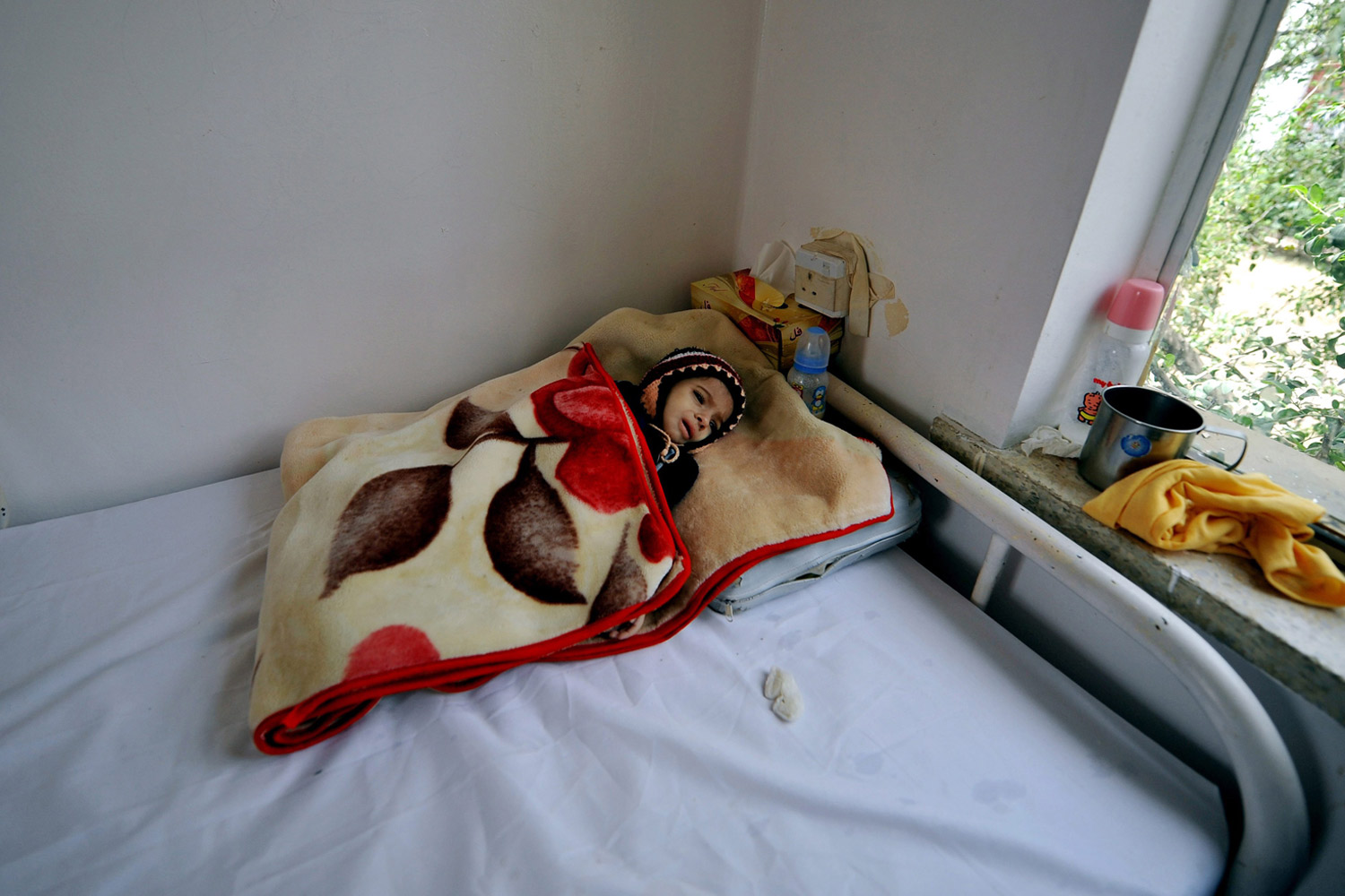 June 2, 2012. A malnourished child lies on a bed at a therapeutic feeding center in a hospital in Sana'a, Yemen.