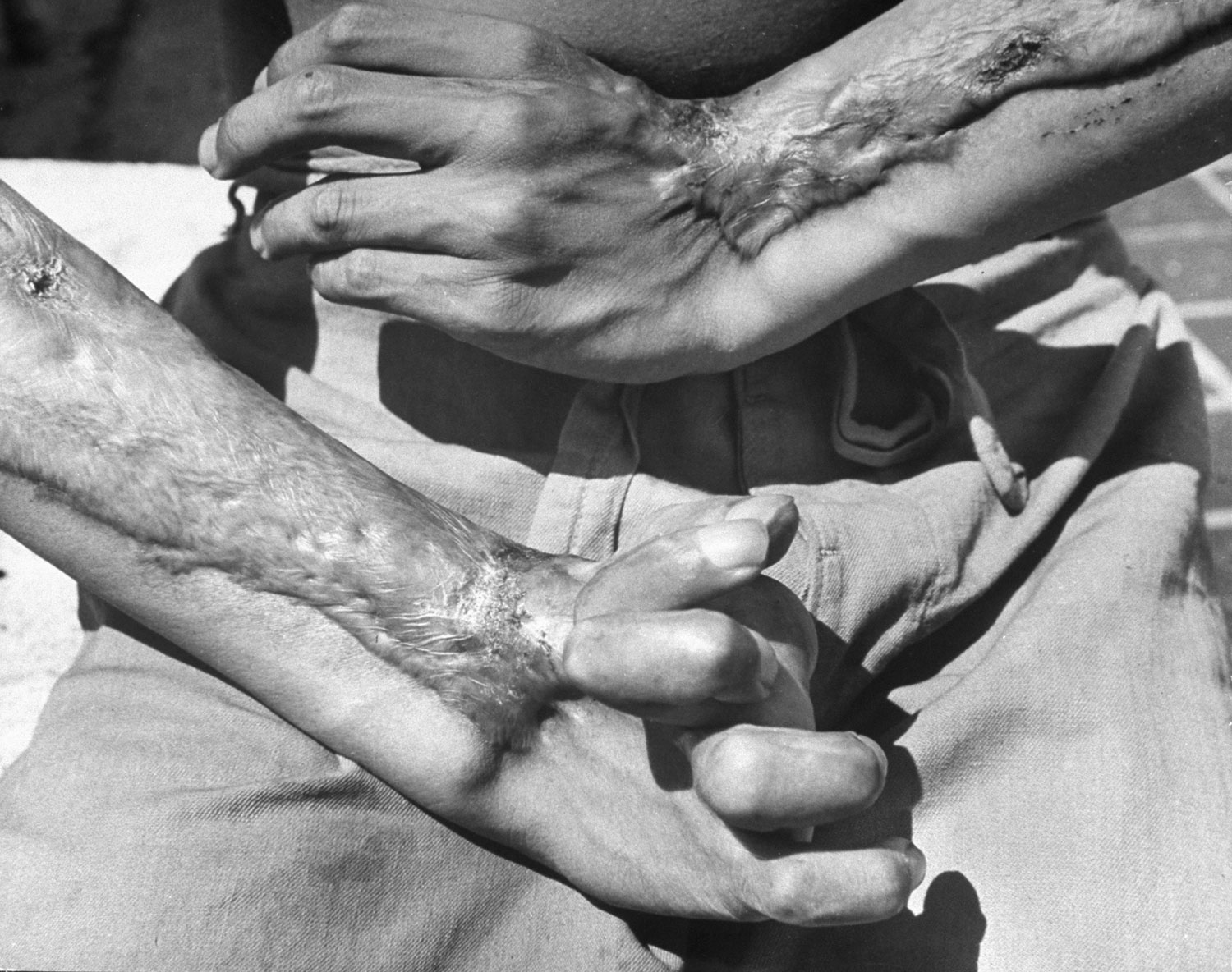 A survivor of the United States' atomic attack on Hiroshima, still hospitalized two years later, shows the damage to his hands, 1947.