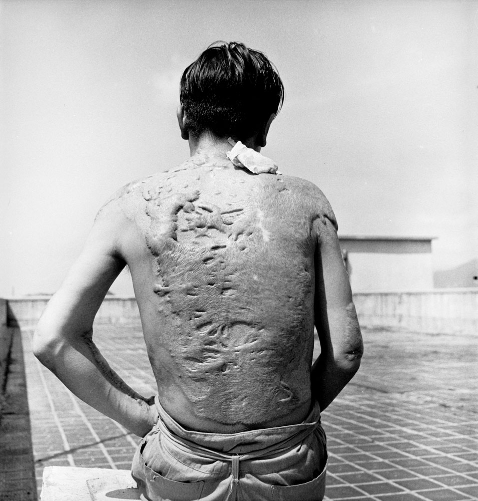 A Japanese Survivors of the United States' August 1945 atomic attack on Hiroshima displays his horribly scarred back two years later, 1947.