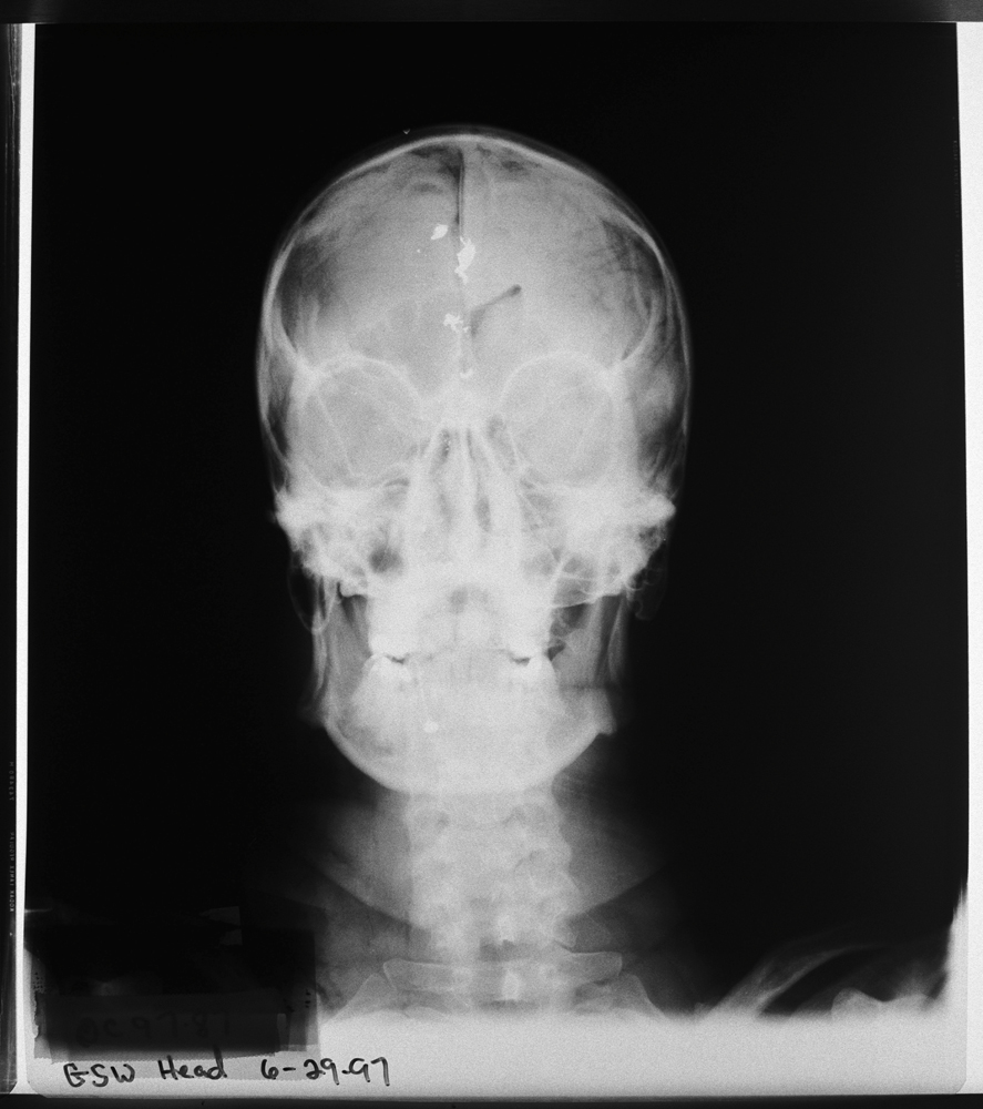 An X-ray of the skull from a suicide death by a self-inflicted gunshot to the head. Gina Taylor, a trauma nurse clinician at Dallas Parkland Hospital says:  We had a rash of men trying to blow their heads off with rifles, but what they didn't account for was the kick of the gun, so when they shot, basically all it did was blow their face off.