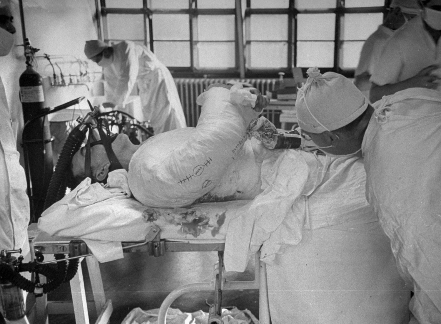 Wounded American Army medic George Lott under anesthesia in France, 1944.