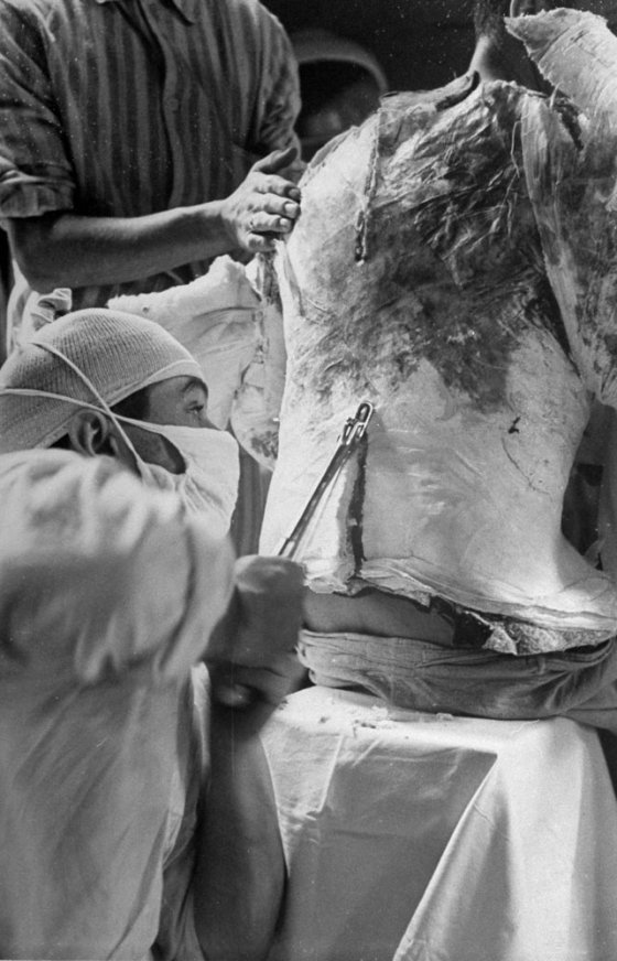 Doctors work on body cast of wounded American Army medic George Lott, 1944.
