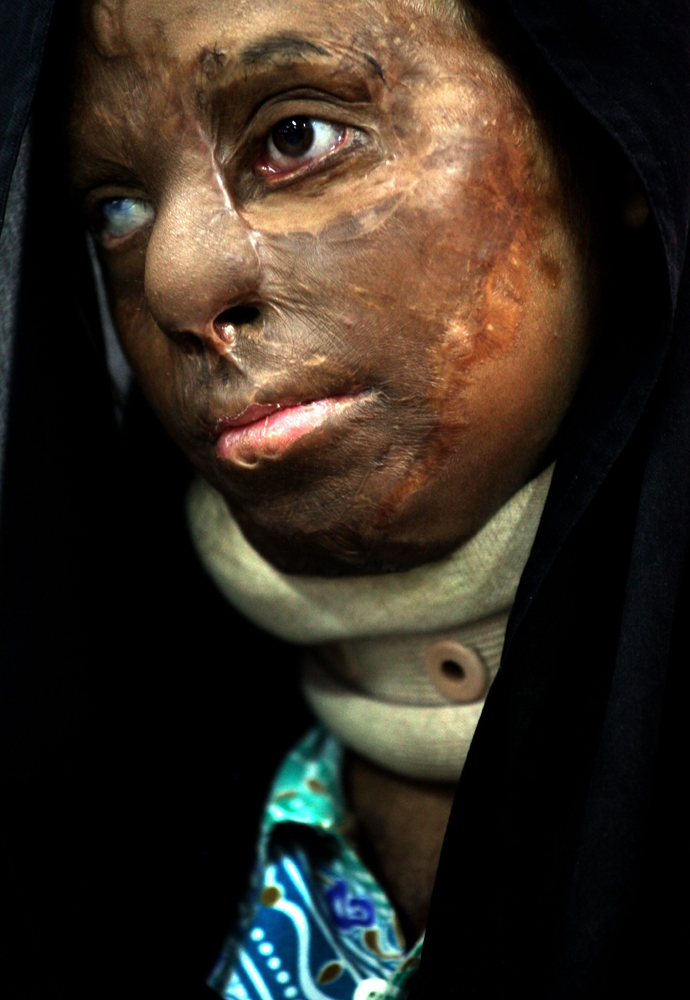 An Indian victim (name not disclosed) of a brutal acid attack is photographed during a seminar held in New Delhi, India