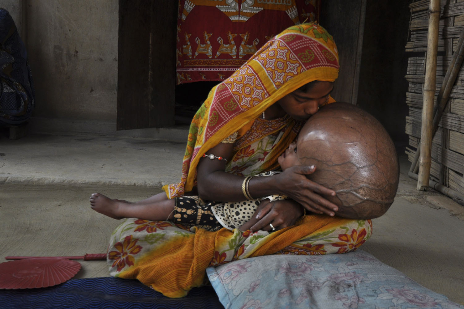 April 13, 2013. Fatima Khatun 25, kisses the head of her eighteen month old daughter, Roona Begum, suffering from Hydrocephalus, in which cerebrospinal fluid builds up in the brain, at their hut in Jirania village on the outskirts of Agartala, the capital of northeastern state of Tripura.