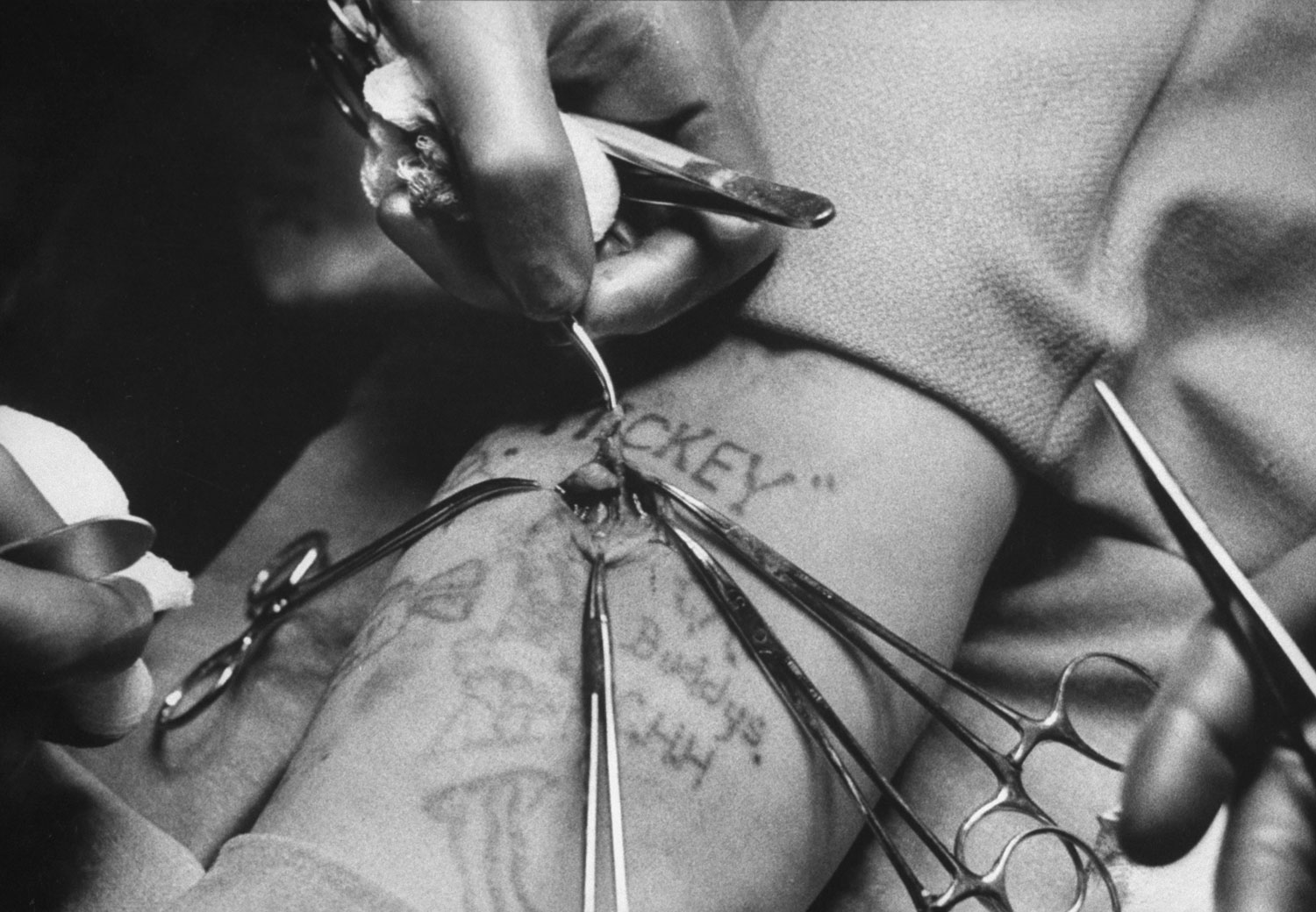 Doctors at Ohio State Penitentiary remove growth of pre-injected cancerous cells from a prisoner's arm, 1958.