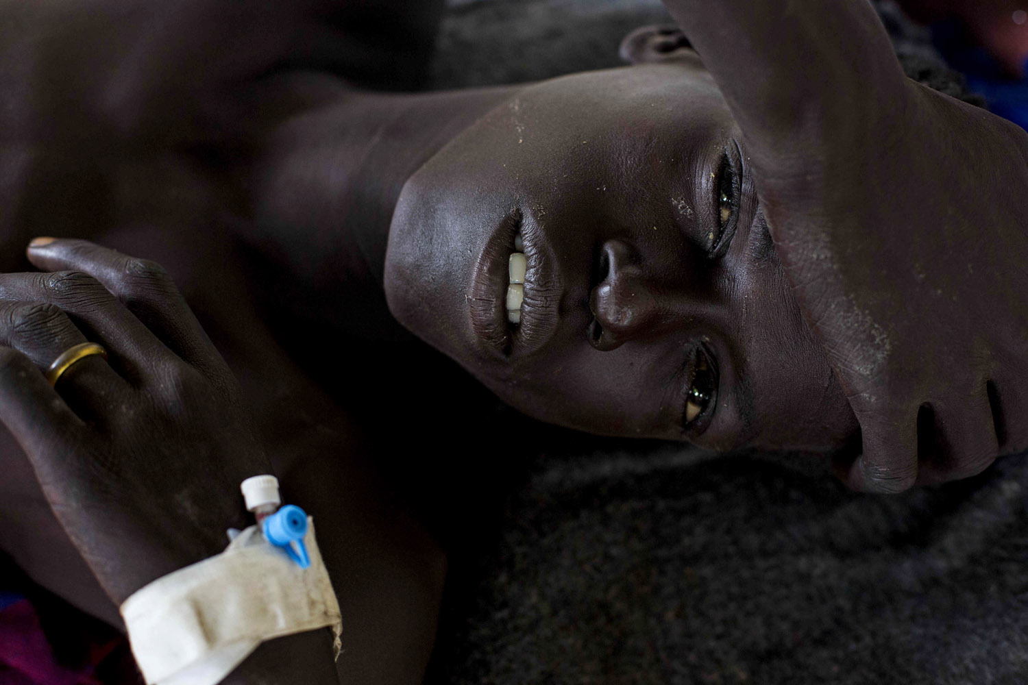 July 15, 2013. A man injured during tribal clashes that erupted in Jonglei State, lies in a hospital in Bor, South Sudan.