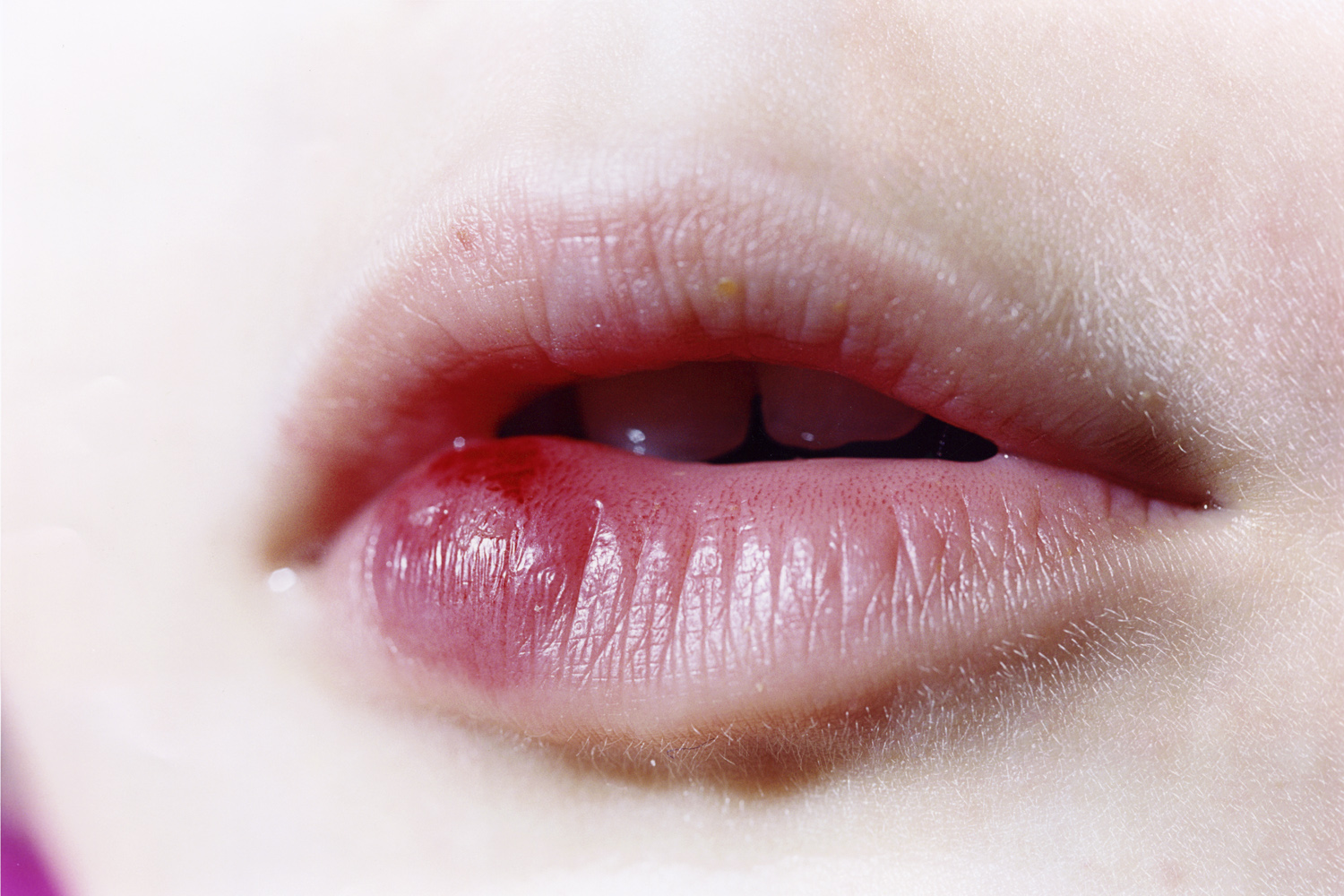 Bruised mouth, 2007