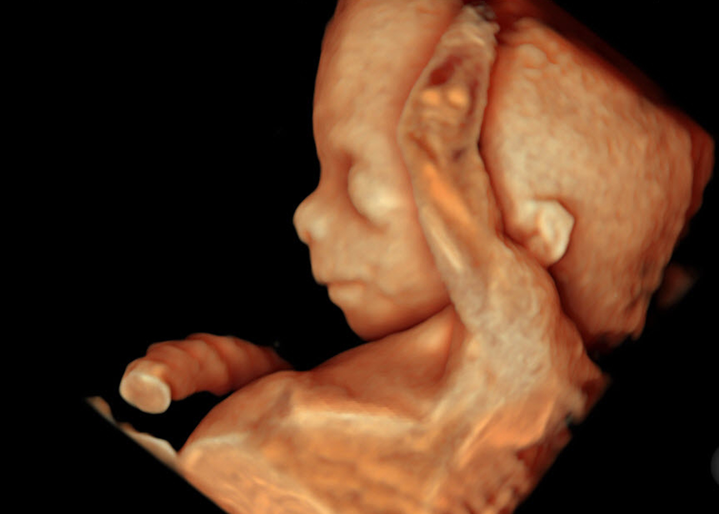 Gestation: 15 weeks.