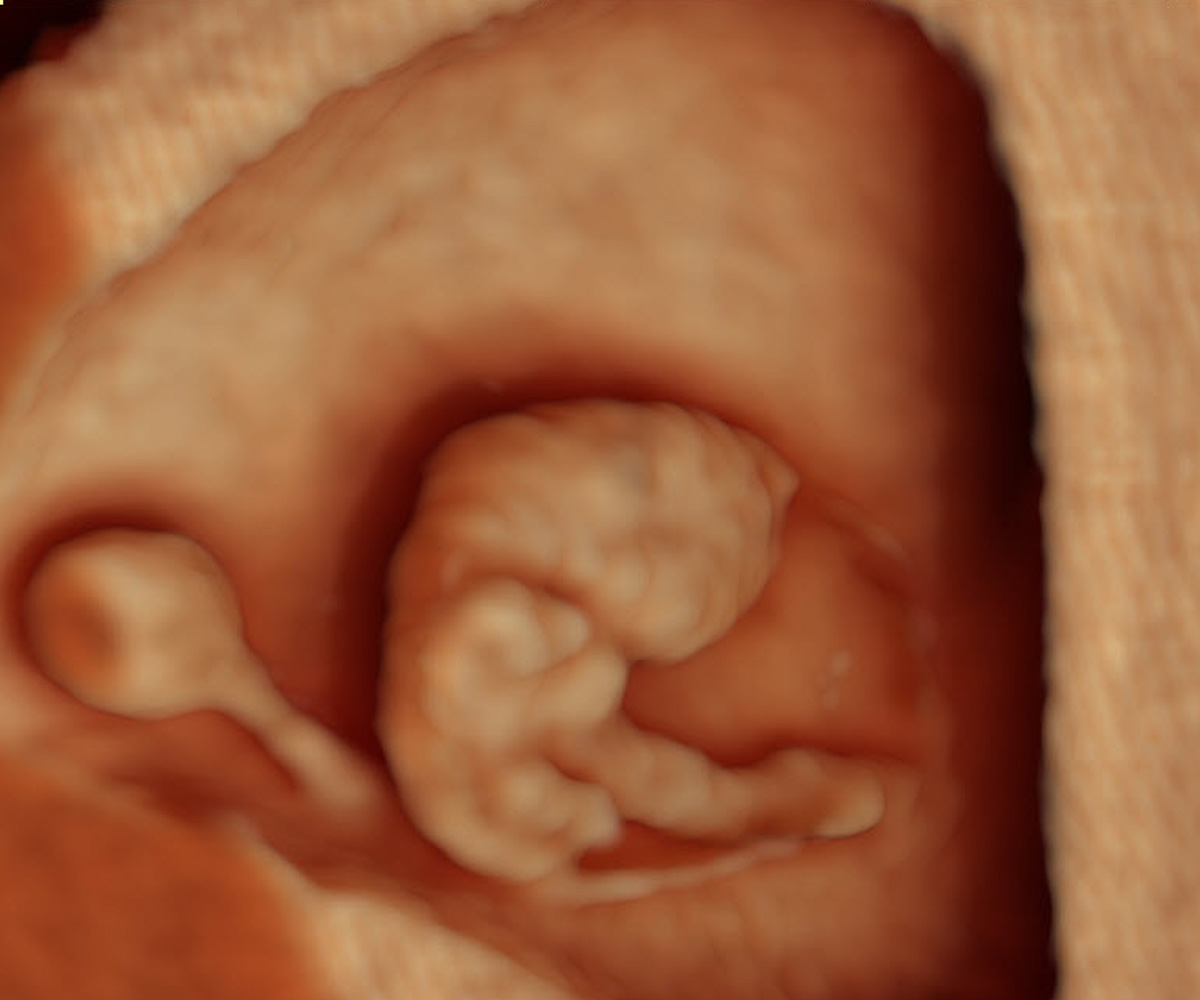 Twins, gestation: 8 weeks.