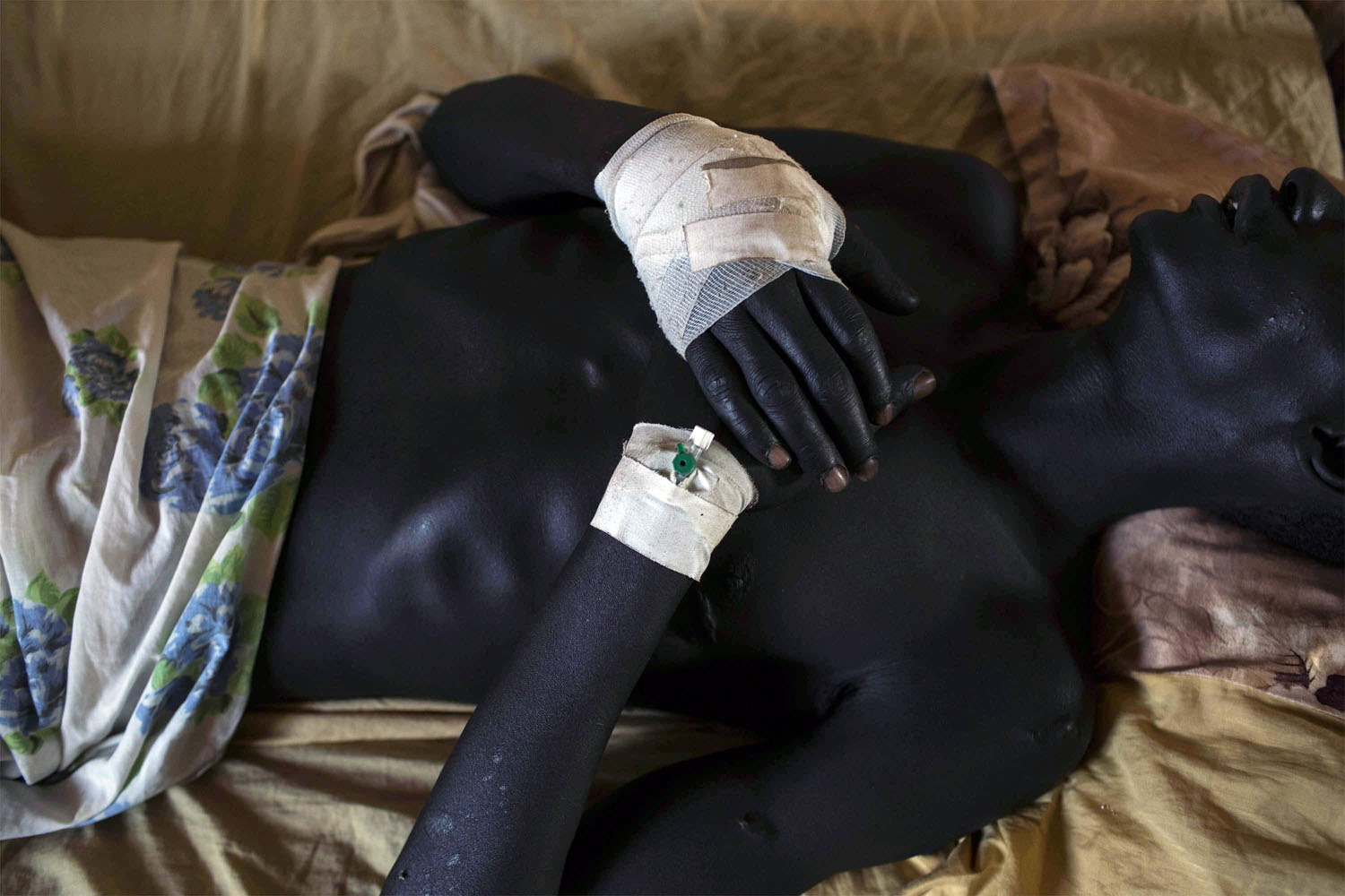 Feb. 11, 2014. An injured soldier is hospitalized at Yirol government hospital supported by by Italian NGP CUAMM, South Sudan.