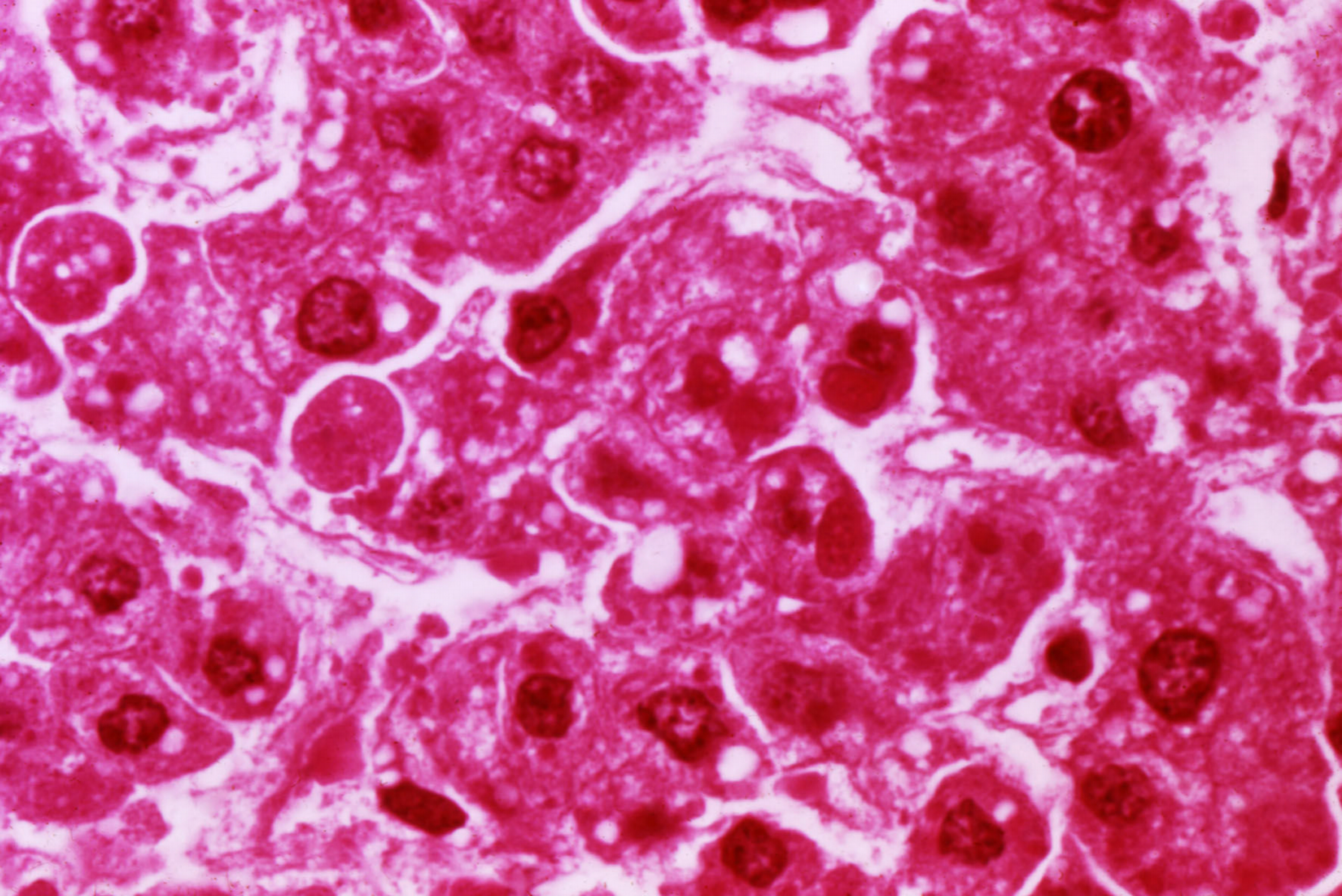 This micrograph reveals human hepatocytes infected with the Ebola virus, the cause of Ebola hemorrhagic fever. The Ebola pathogen is a member of the Filoviridae family of RNA viruses. It is known to be spread through close contact with an infected host. (Media for Medical / UIG via Getty Images)