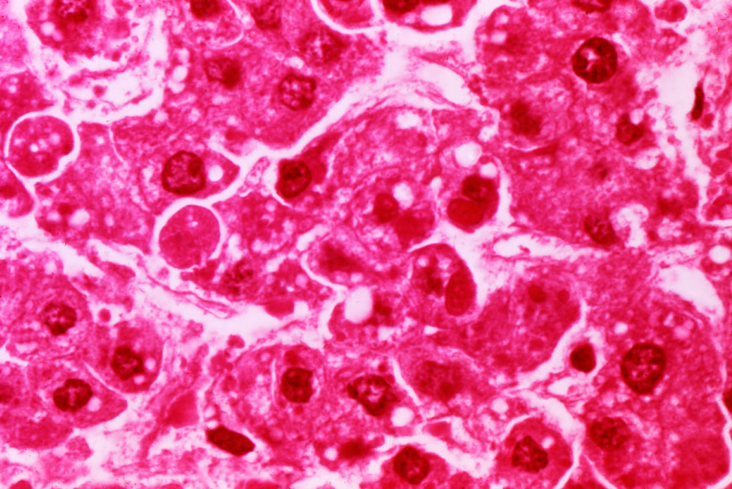 This micrograph reveals human hepatocytes infected with the Ebola virus, the cause of Ebola hemorrhagic fever.
