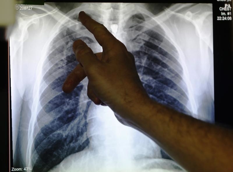 Clinical lead Doctor Al Story points to an x-ray showing a pair of lungs infected with TB (tuberculosis) during an interview with Reuters  on board the mobile X-ray unit screening for TB in Ladbroke Grove in London