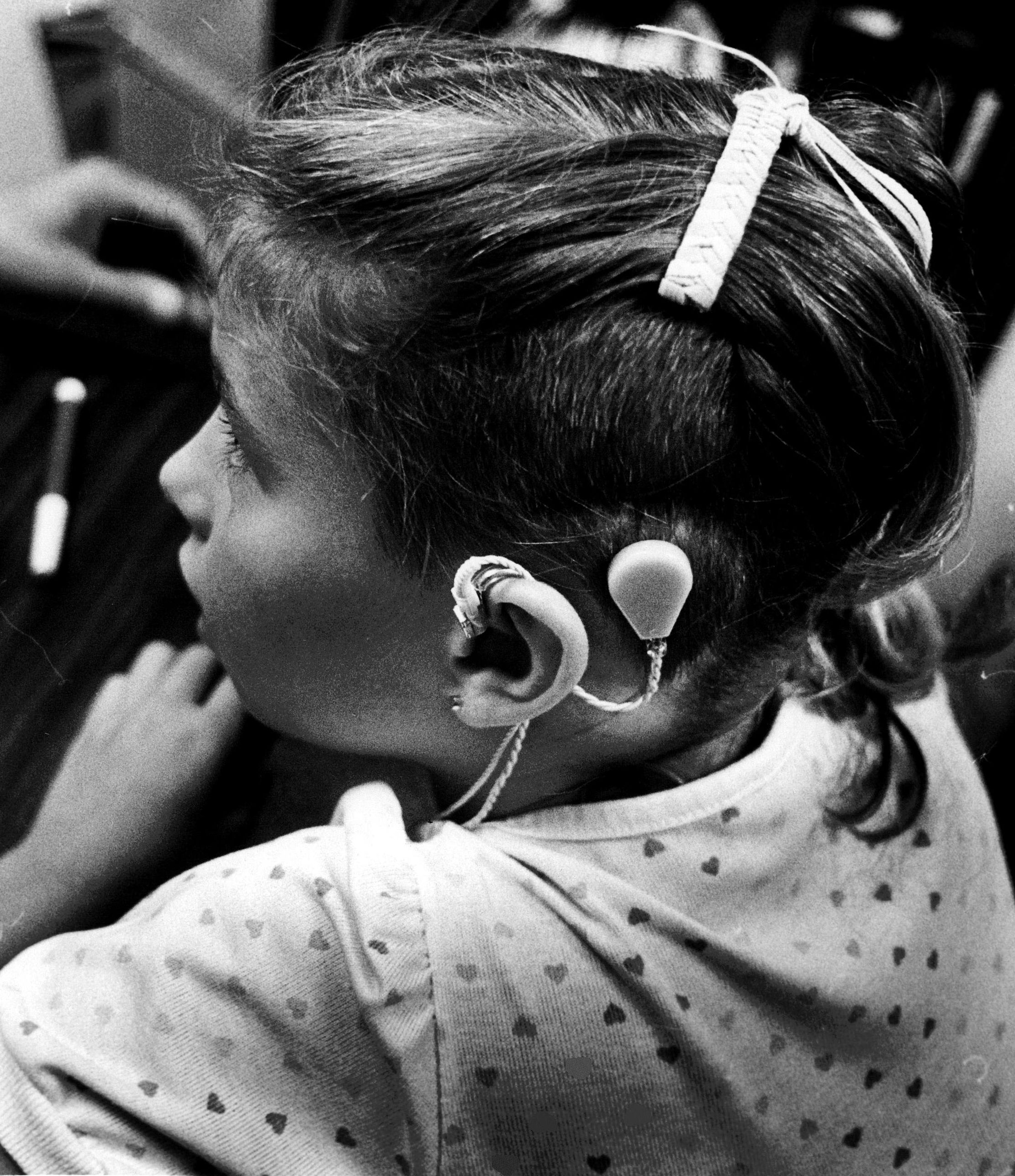 A child with an early cochlear implant on Aug. 24, 1984.