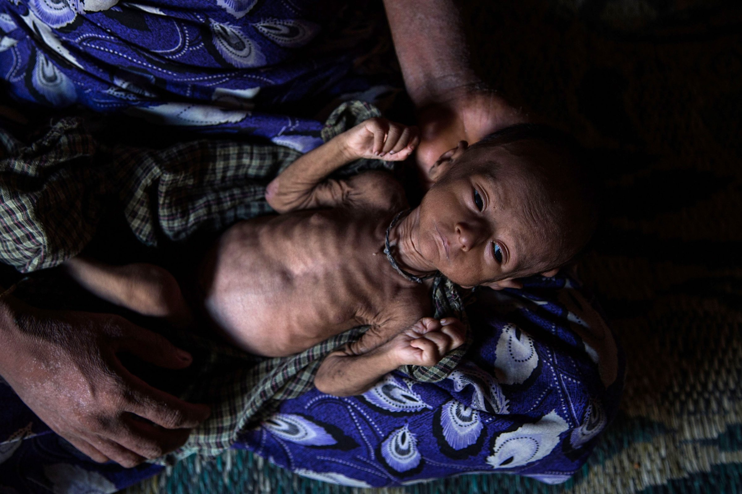 Rohingya Refugees Face Health Crisis As Myanmar