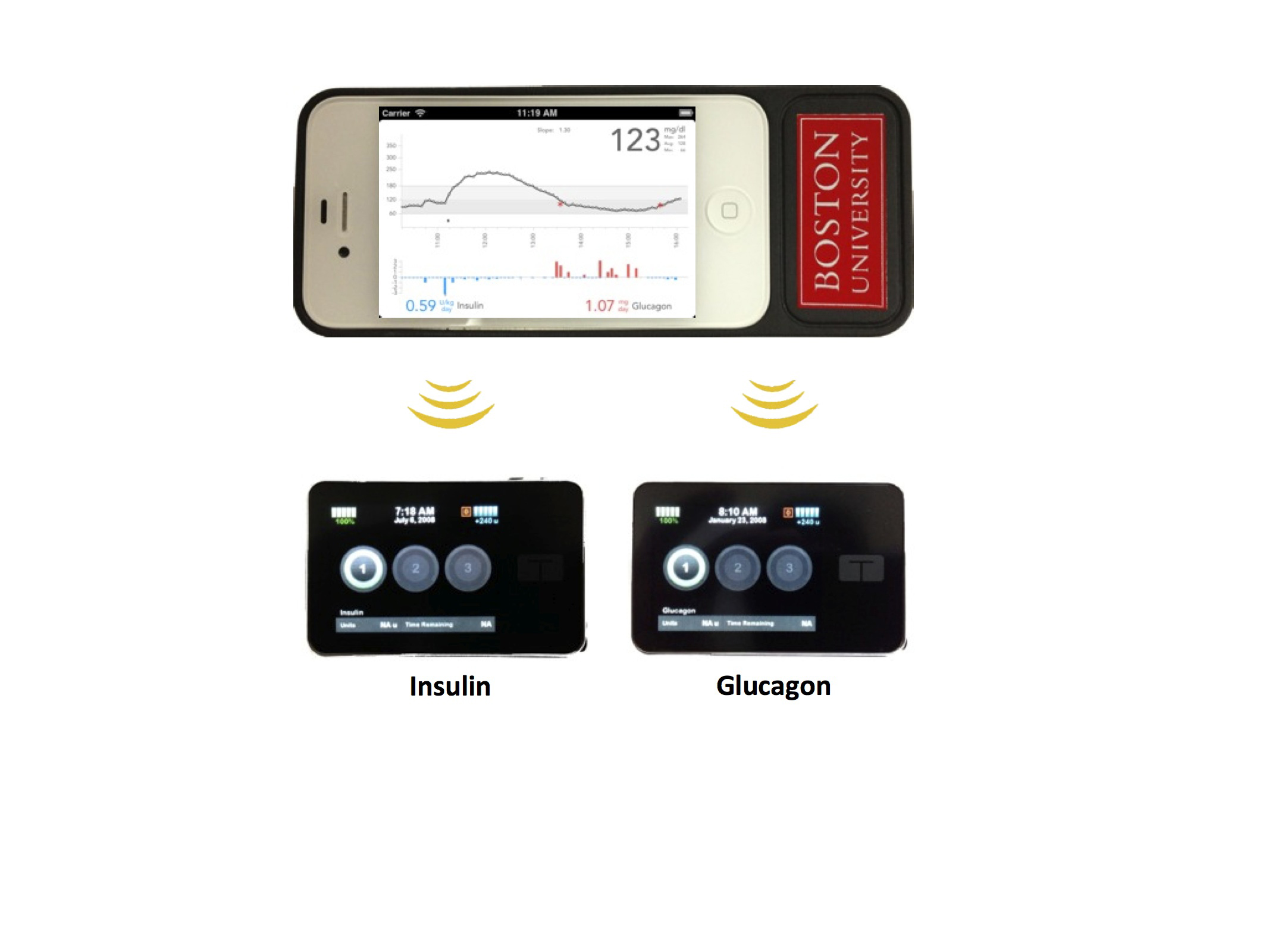 The bionic pancreas consists of a smartphone, top, hardwired to a continuous glucose monitor and two pumps, bottom, that pumps deliver doses of insulin or glucagon every five minutes.
