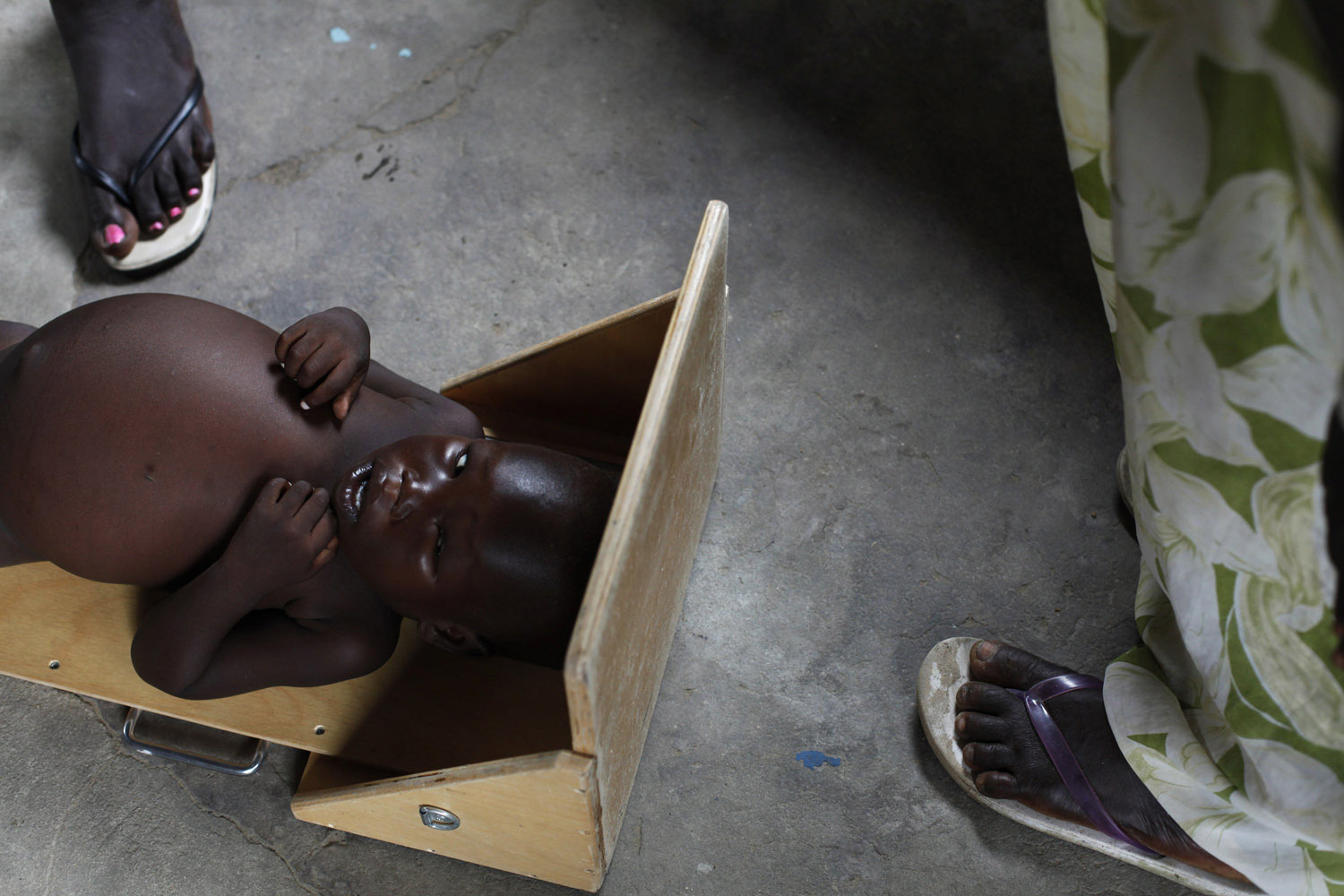 A severely malnourished child is measured at the Medecins Sans Frontieres feeding centre in Leer