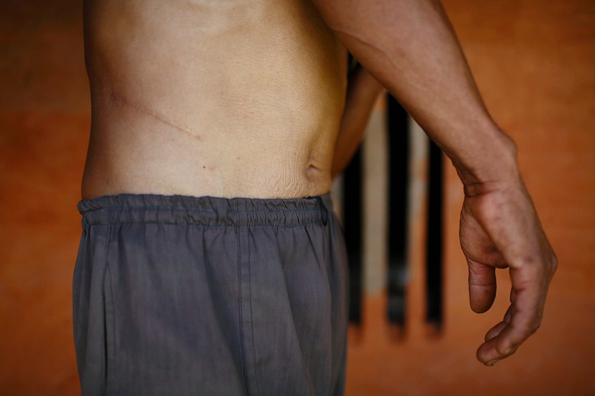 Man Bahadur Tamang, 51, who sold his kidney for 64,000 Nepalese rupees ($727) due to poverty, shows the incision scar from the operation, at his home in Kavre