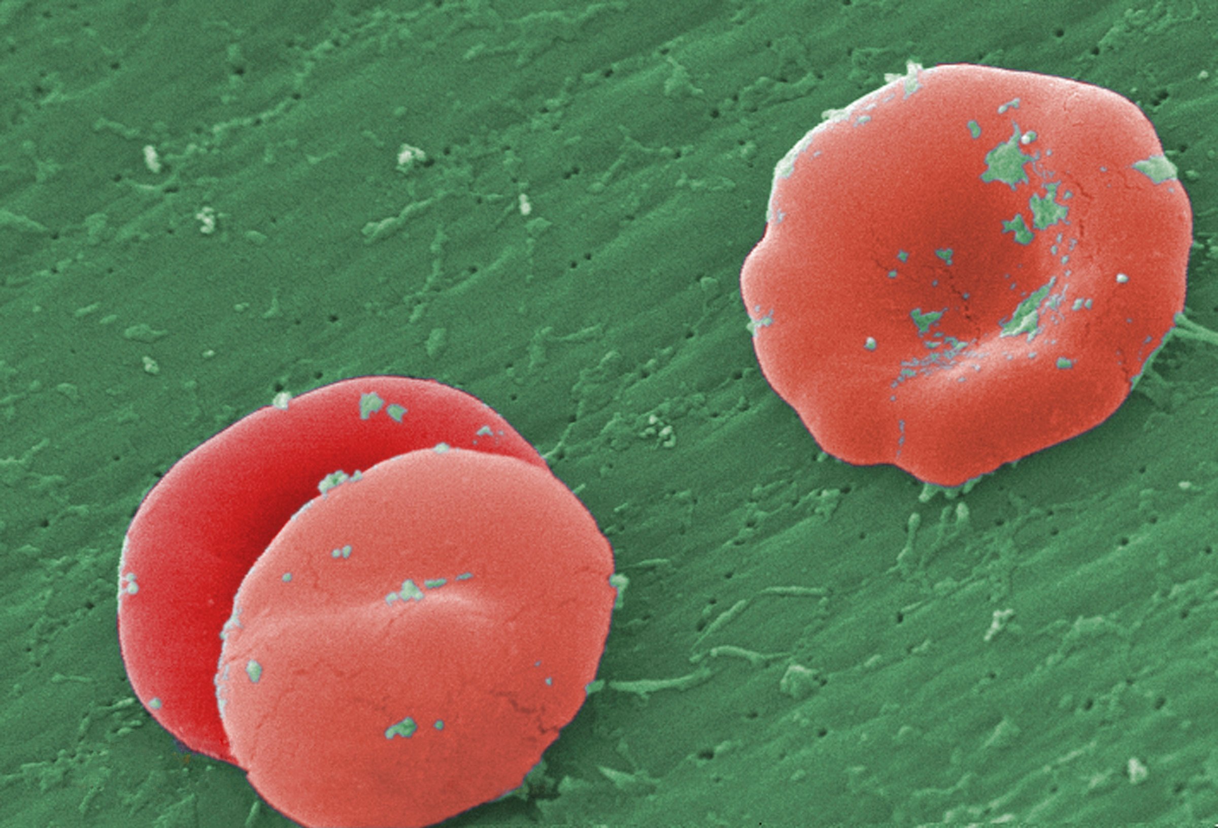 Sickle Cell Anemia SEM