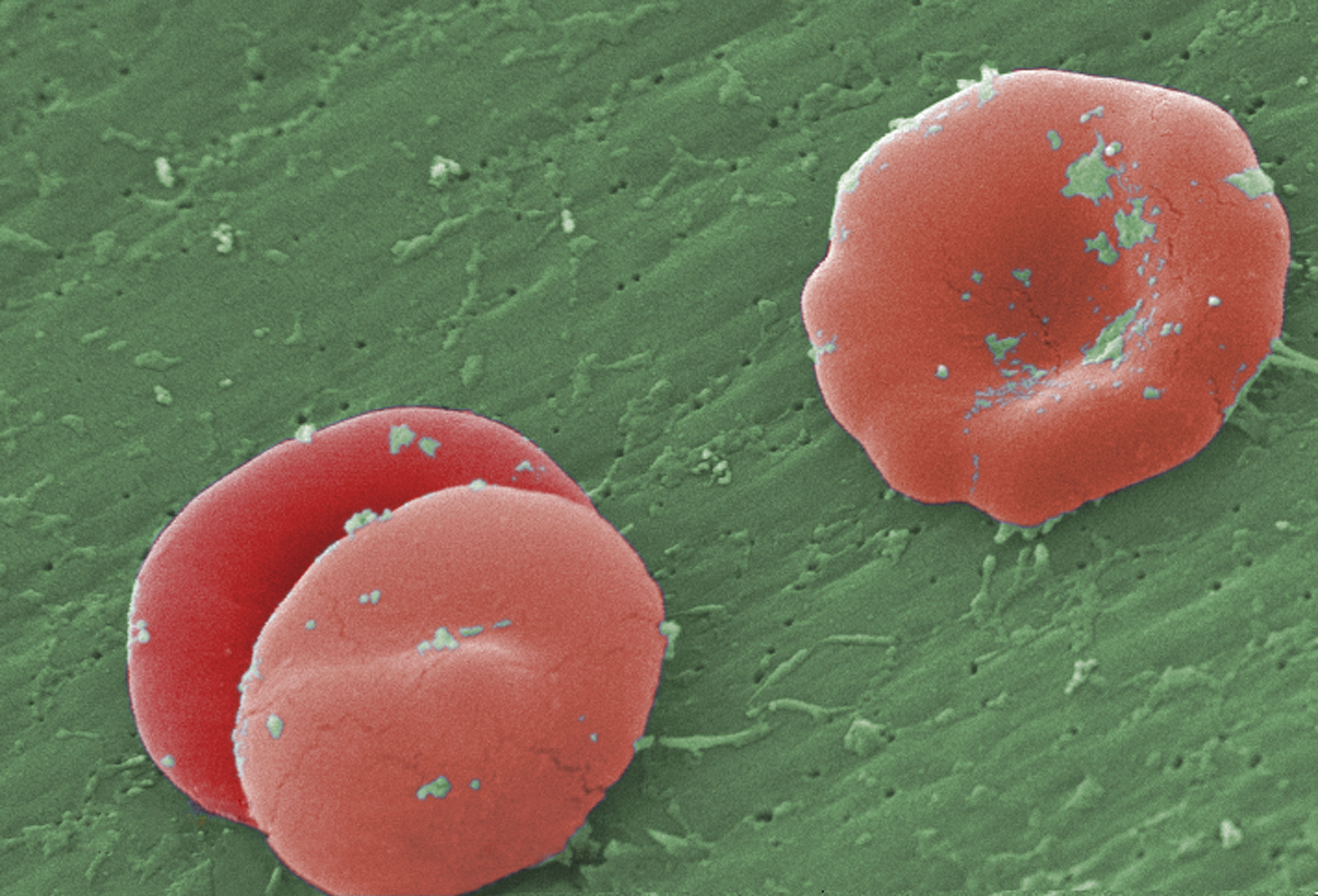 Under a high magnification of 8000X, this scanning electron micrograph reveals red blood cells in a 6-year-old male patient with sickle cell anemia. (Media for Medical—UIG/Getty Images)
