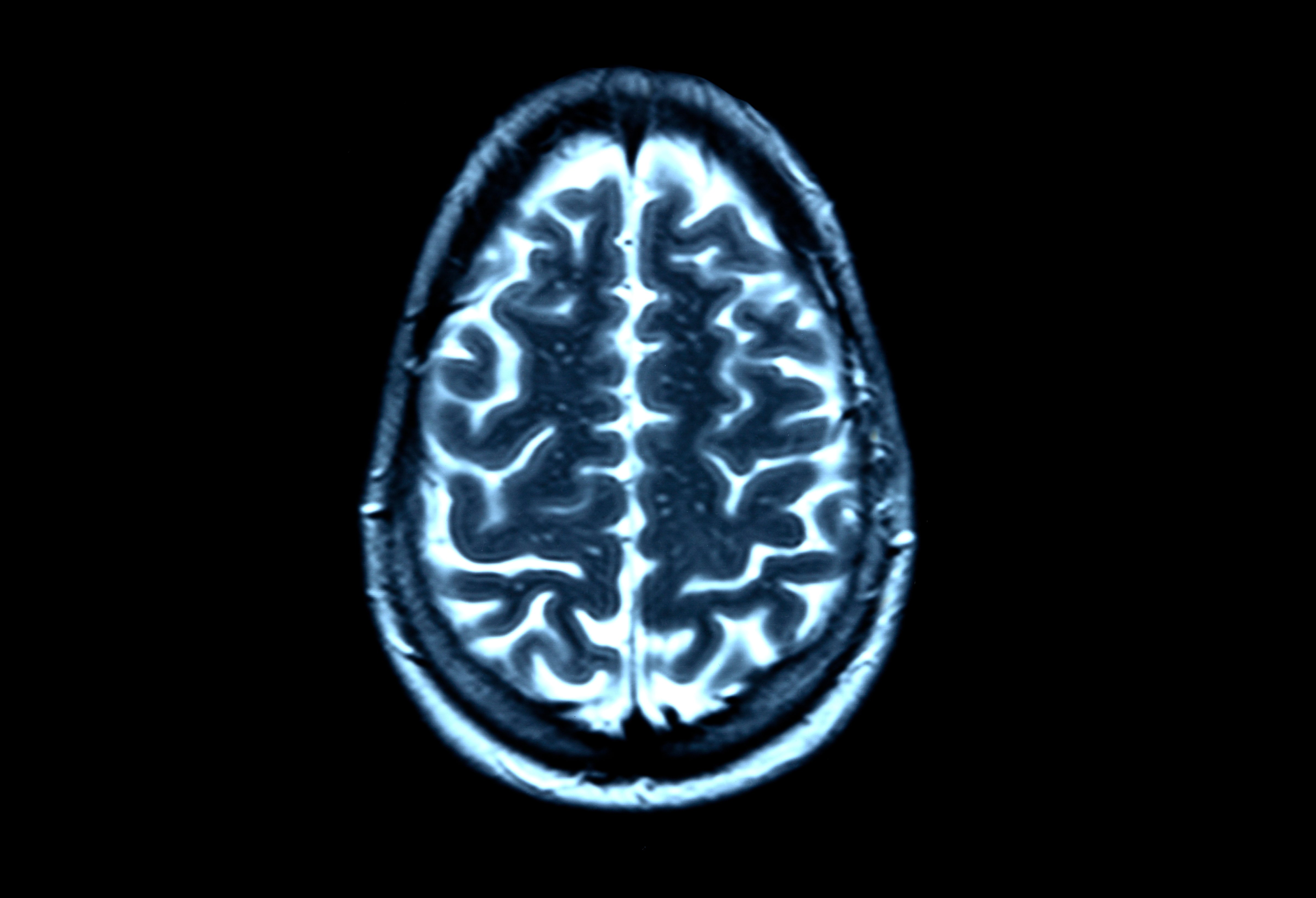 Brain scan, MRI scan