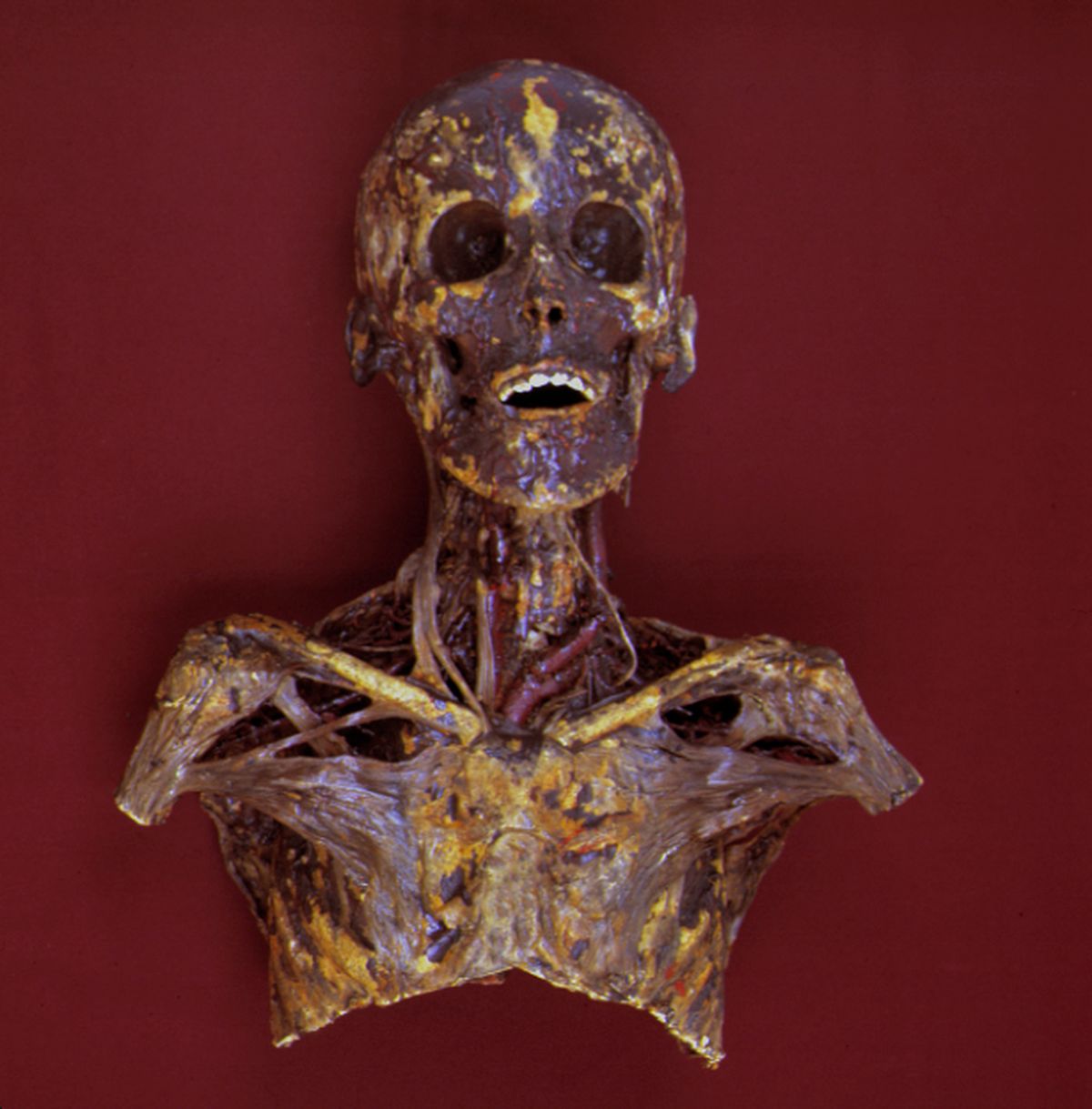 This mummy shows part of the head, the neck and the shoulder area, with an emphasis on the anatomy of the neck area.