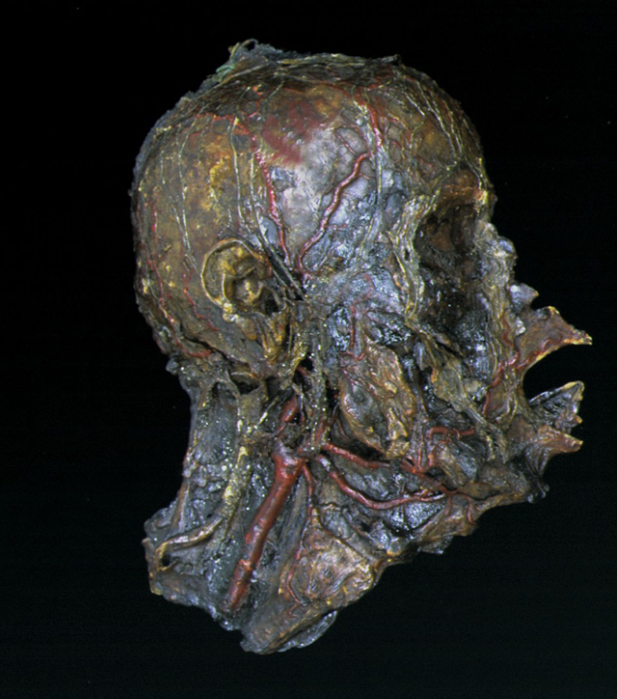 This is an example of a head showing different anatomical structures. This head has been fully dissected to show various blood vessels and connective tissues in great detail