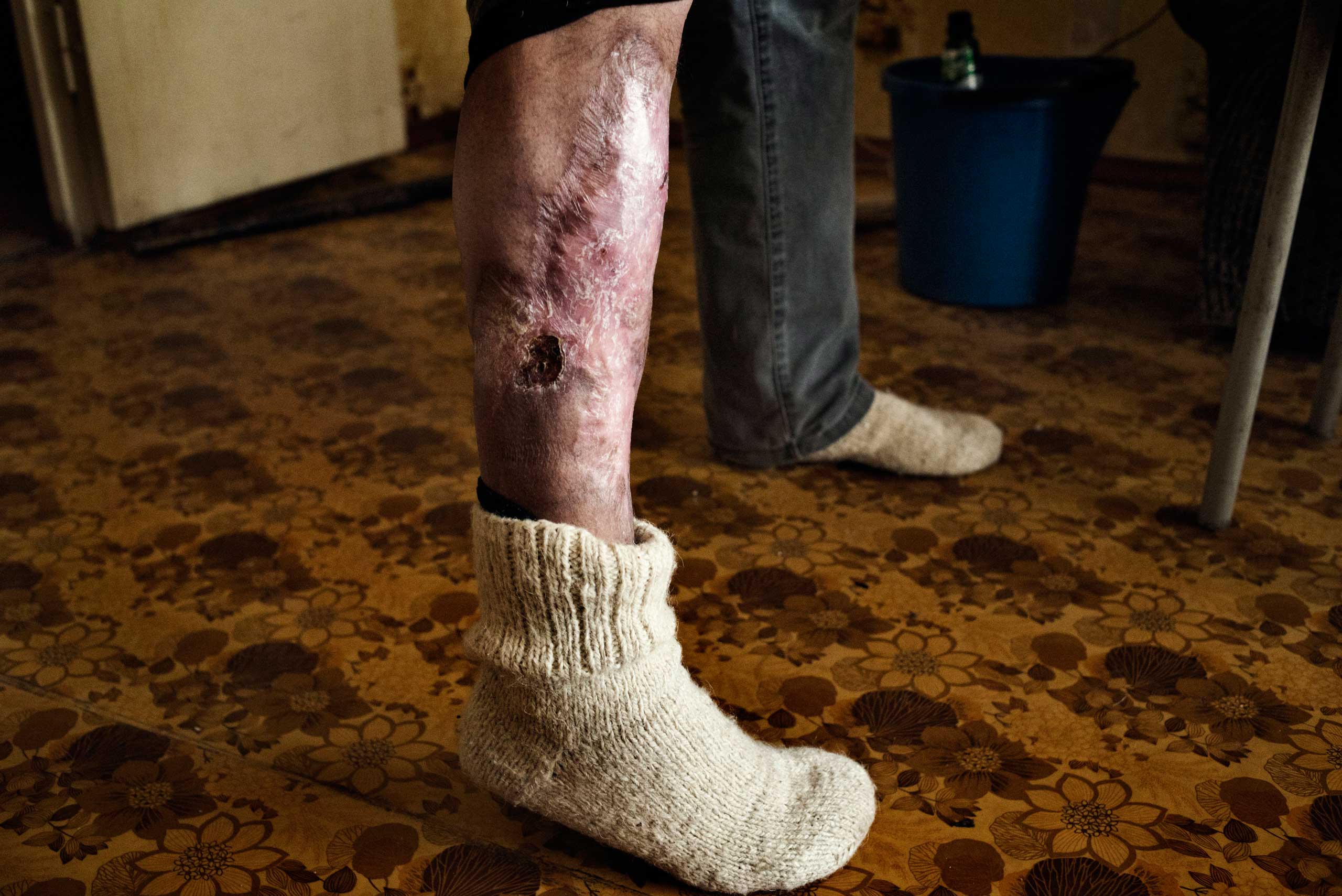 Pavel, 31 years old, shows the effects of the krokodil on his skin. The chemicals used to prepare krokodil cause deep wounds and sores.