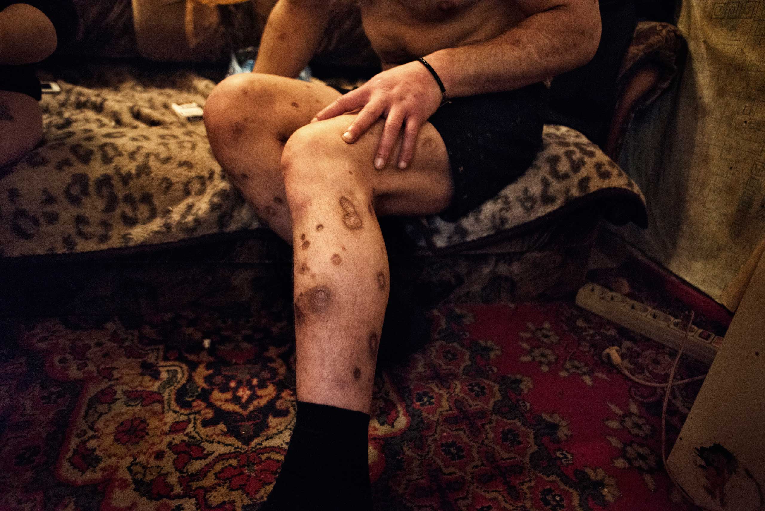 Elman, 40 years old, displays the injuries on his legs which hes says were caused by the use of krokodil and methadone.