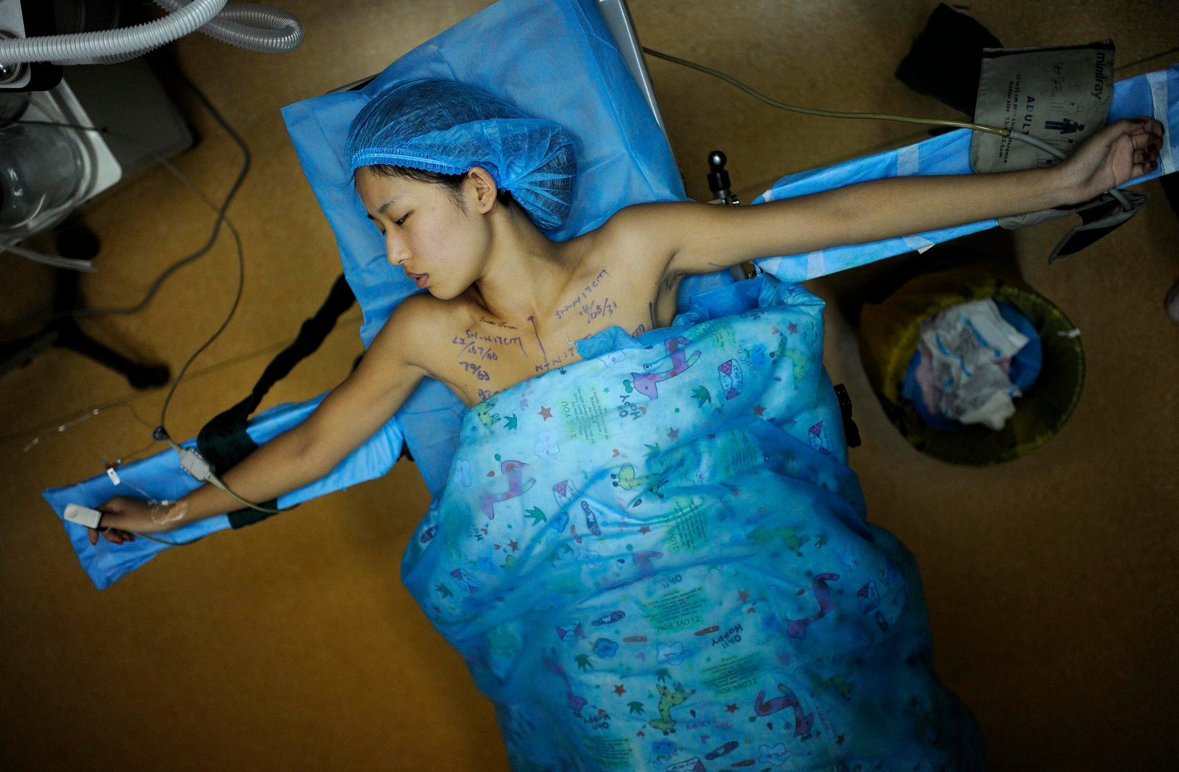Feifei, 21, undergoes a breast implant surgery at a hospital in Hefei, Anhui province, China on September 1, 2014. Feifei, a third-year university student and a part-time model, received a free breast implant surgery in return for advertising for the hospital. Around 10 days after the operation, she won a prize at a local beauty contest.