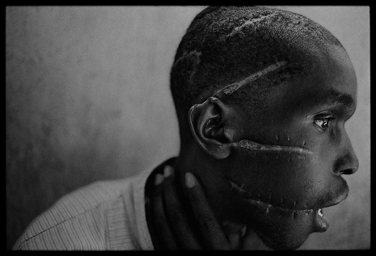 A Hutu man who did not support the genocide had been imprisoned in the concentration camp, starved and attacked with machetes. He managed to survive after he was freed and was placed in the care of the Red Cross, Rwanda, 1994.