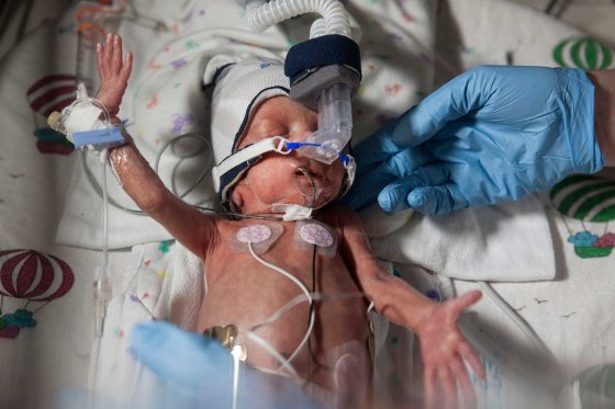 The following images were taken by Elinor Carruci in February 2014. David, an infant born at 28 weeks gestation, is seen in an incubator at the Children's Hospital of Wisconsin.