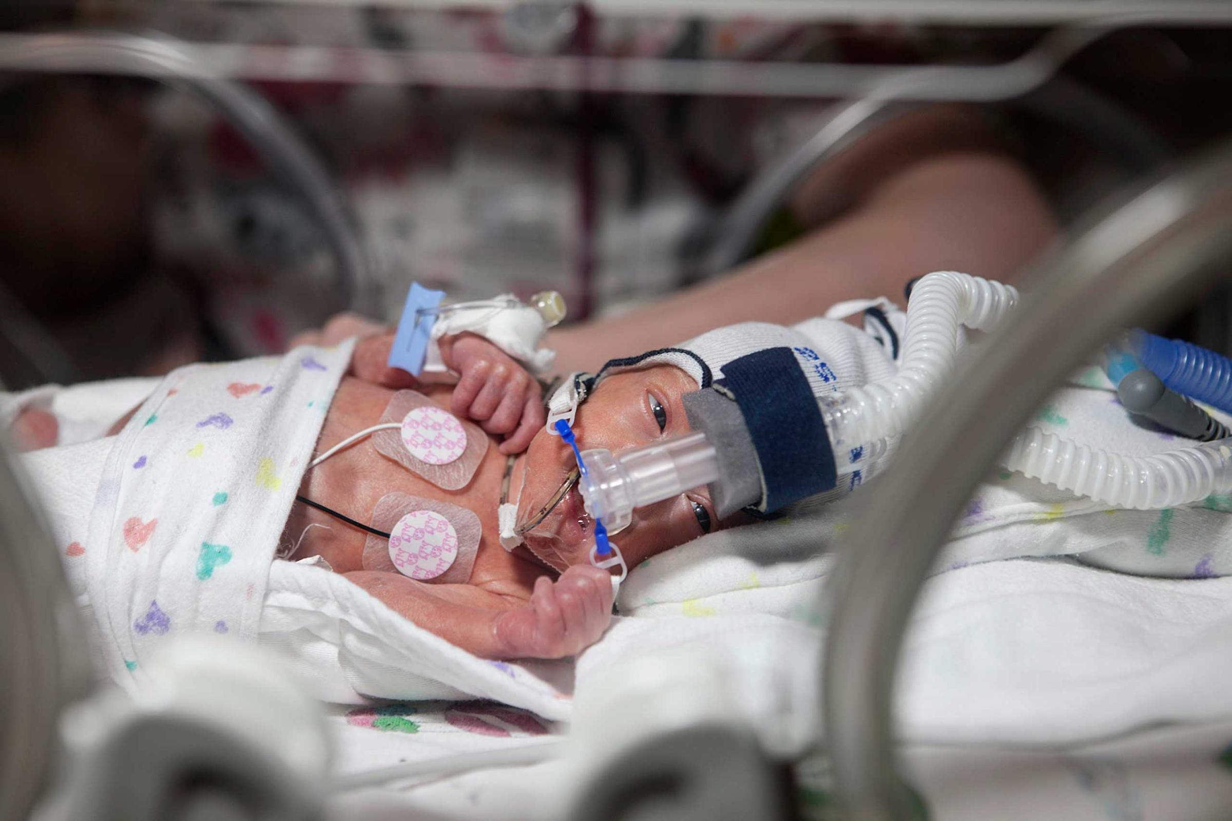David is seen in an incubator at the Children’s Hospital of Wisconsin.
