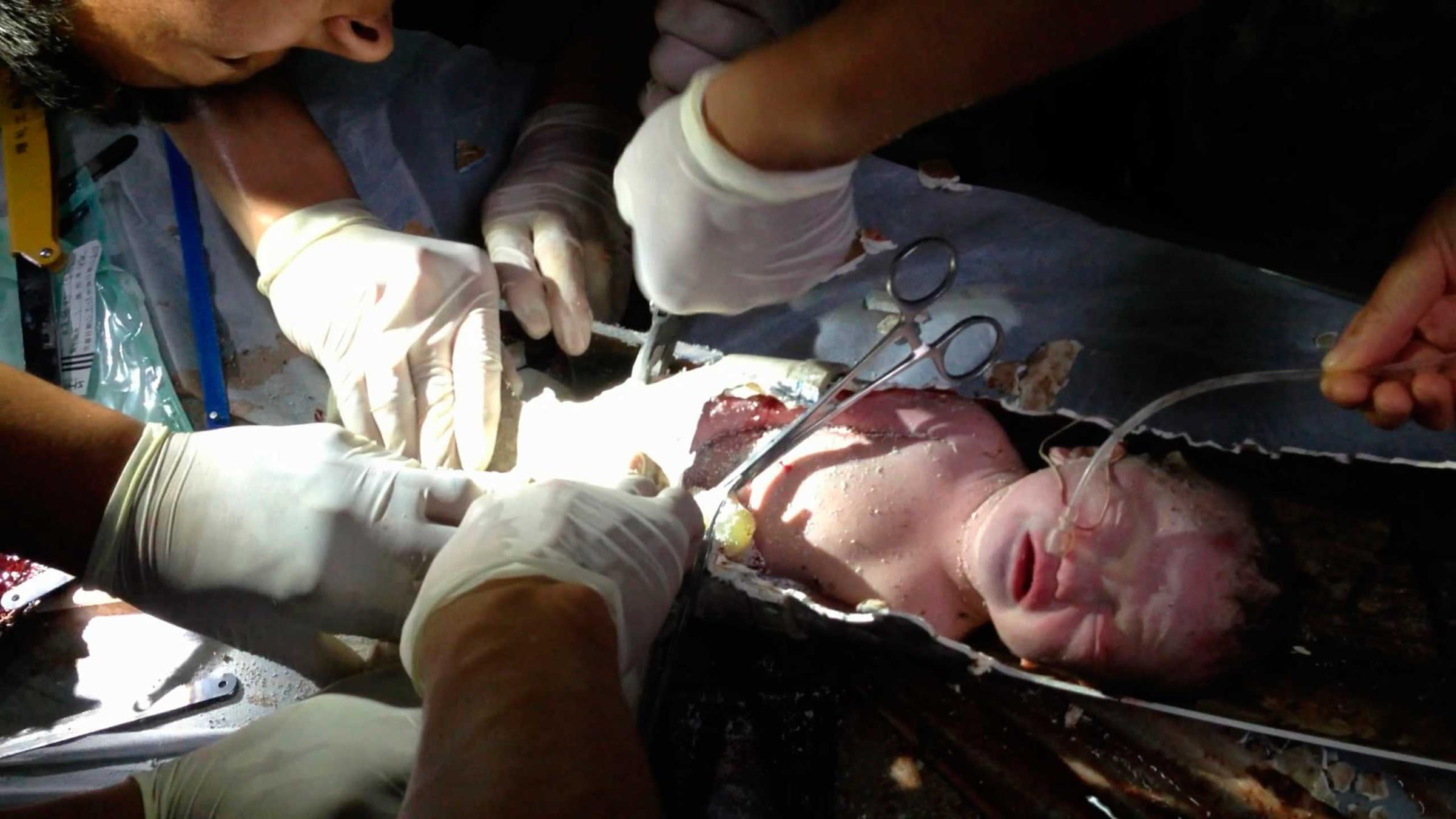 Firefighters and doctors rescue an abandoned newborn baby boy by cutting away a sewage pipe piece by piece, in this still image taken from video, at a hospital in Jinhua