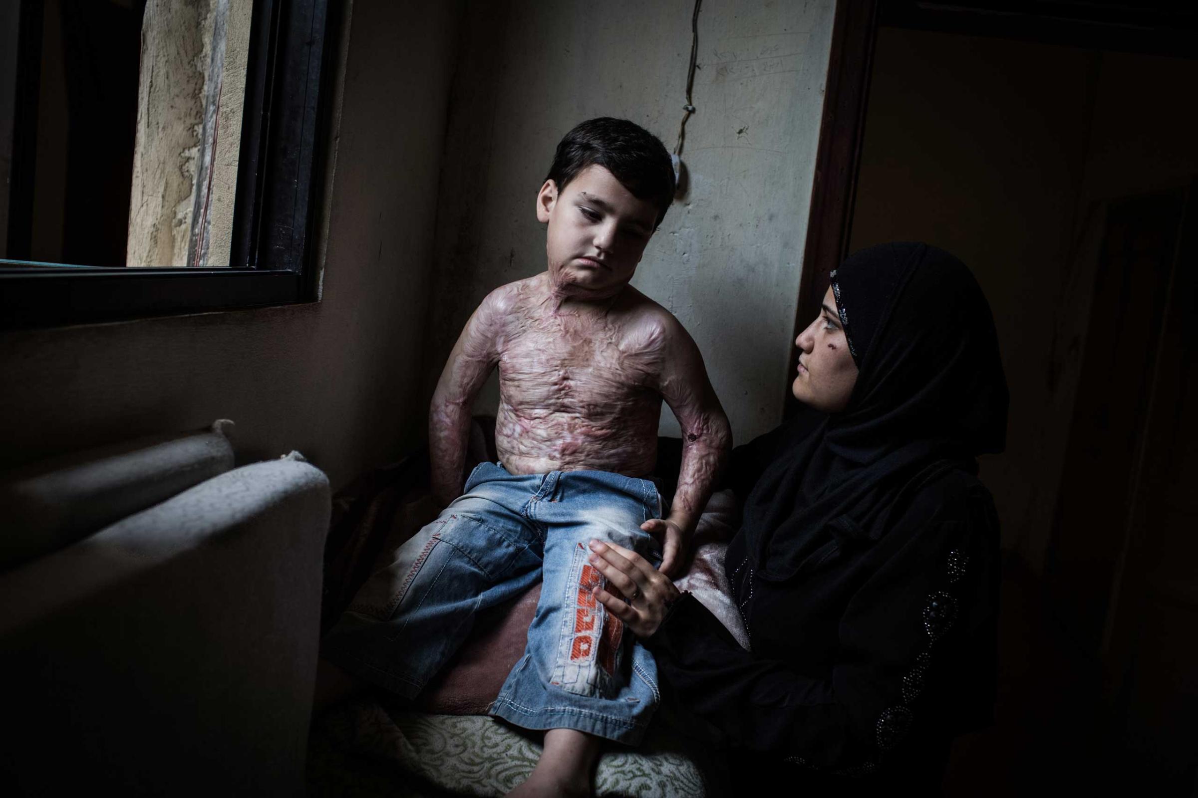 Mohammed, 7, with his mother at a shelter in Donnyeh, Lebanon, June 27, 2014. He was burned by shelling in Homs two years ago; he spent a year getting wounds cleaned and needs several operations and skin grafts.