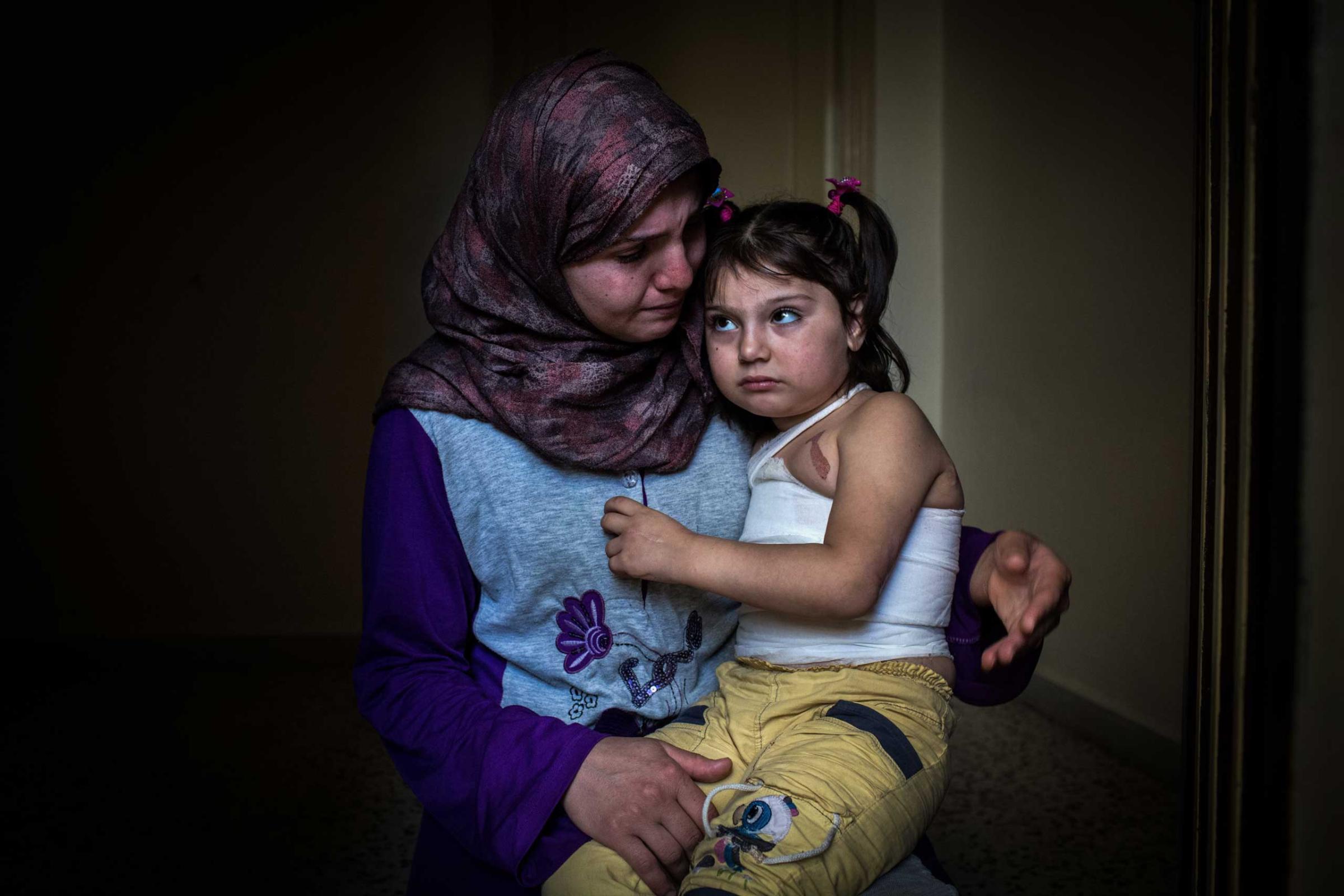 Yemen, 5, and her mother at home in northern Lebanon, on June 27, 2014. The girl was scalded by boiling water as bombs fell close to her home in November. Her mother carried her to Lebanon days later and said she'll need plastic surgery.
