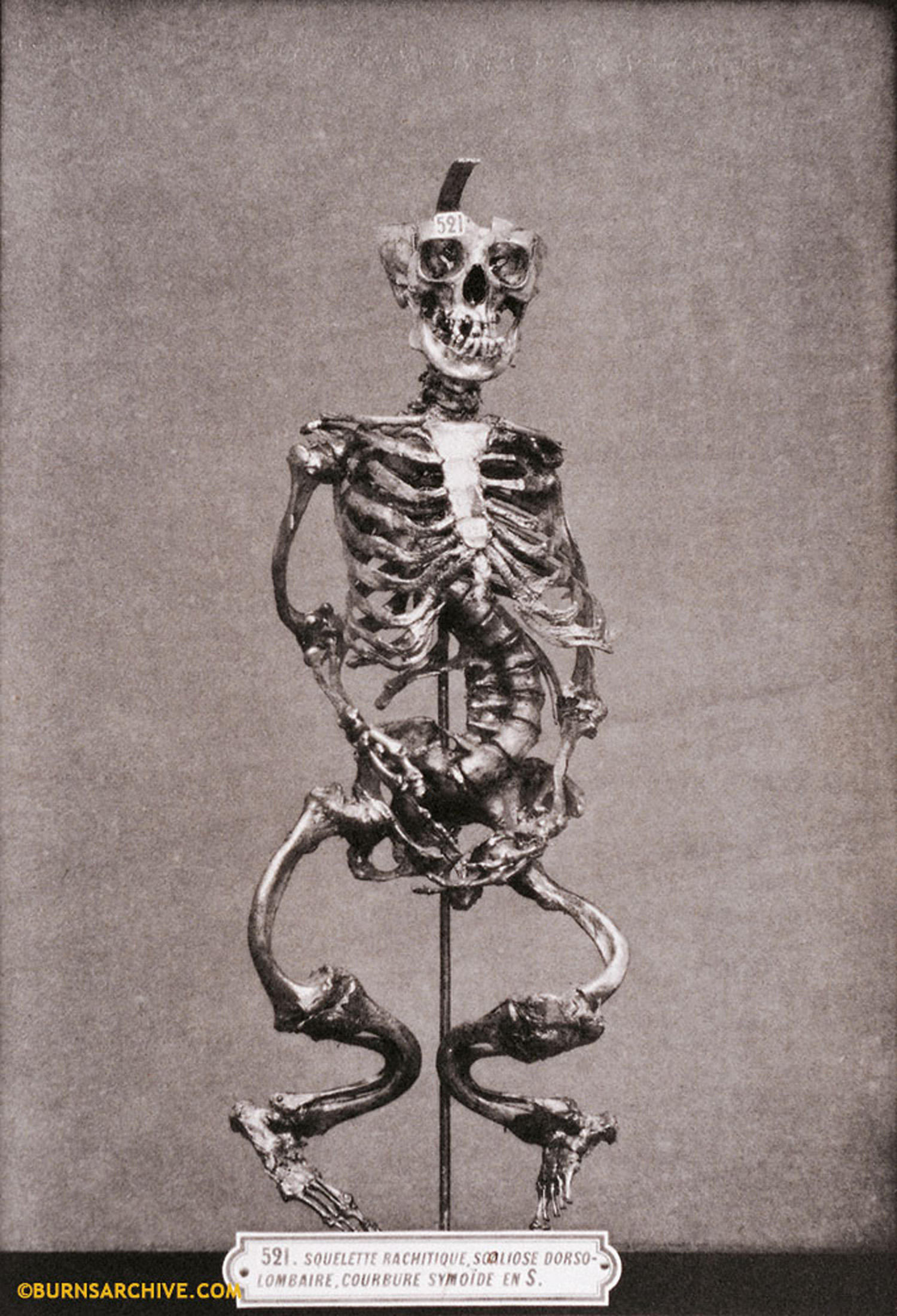Deformed Skeleton Due to Rickets, 1879