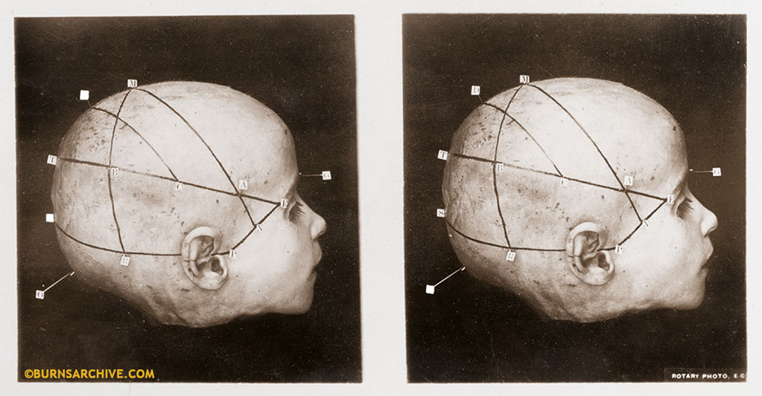 Cranio-cerebral Topographical Study of A Child’s Head, 1916