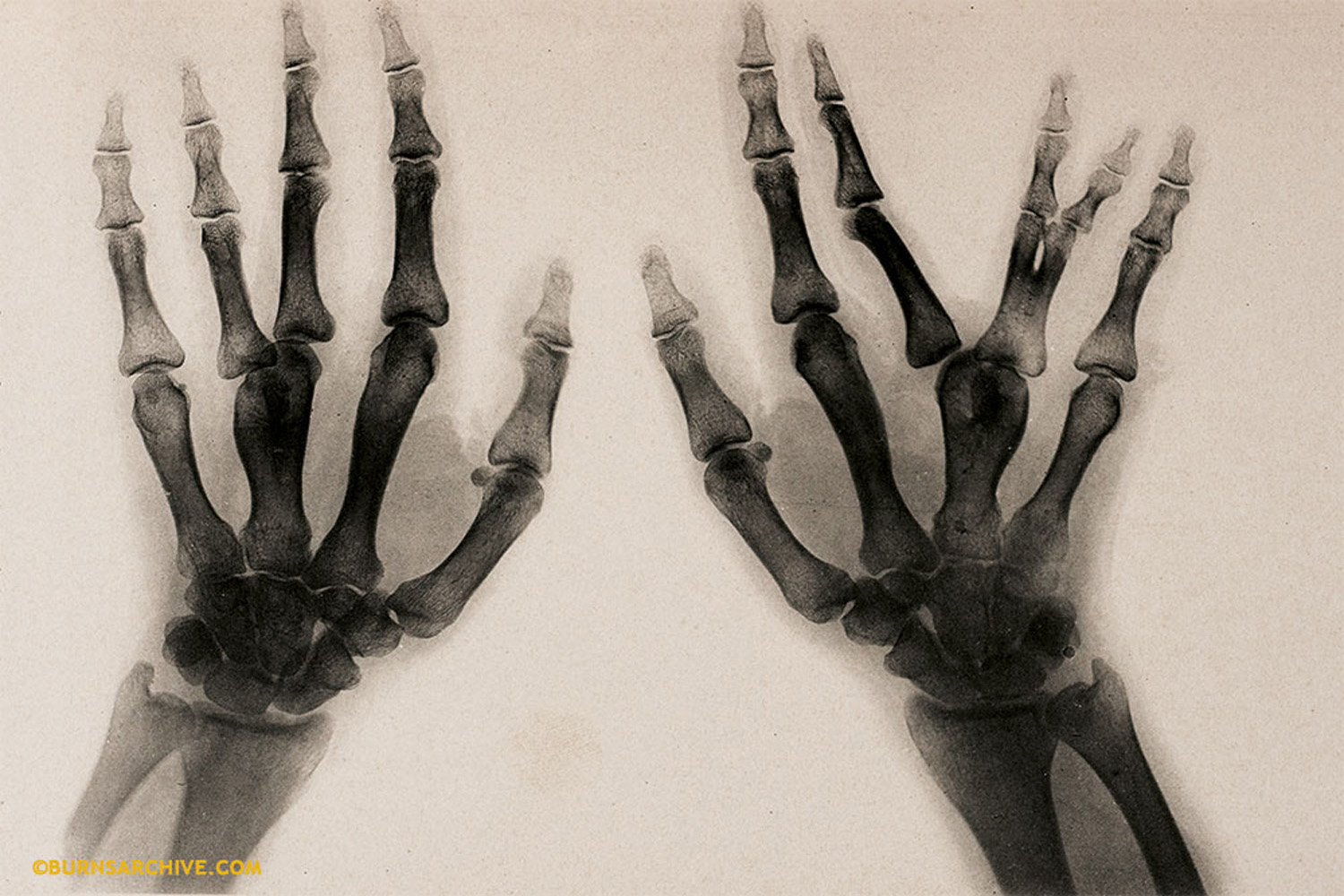 X-Ray of Deformity of Hand, Fused Metacarpal Bones, 1907
