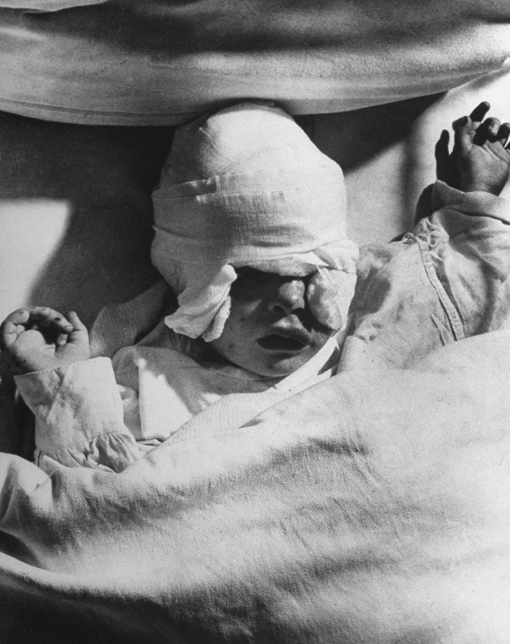 1940 | A heavily bandaged British infant, Margaret Curtis, badly injured in a German blitzkrieg attack on London during the Battle of Britain. Originally published in the September 9, 1940, issue of LIFE.