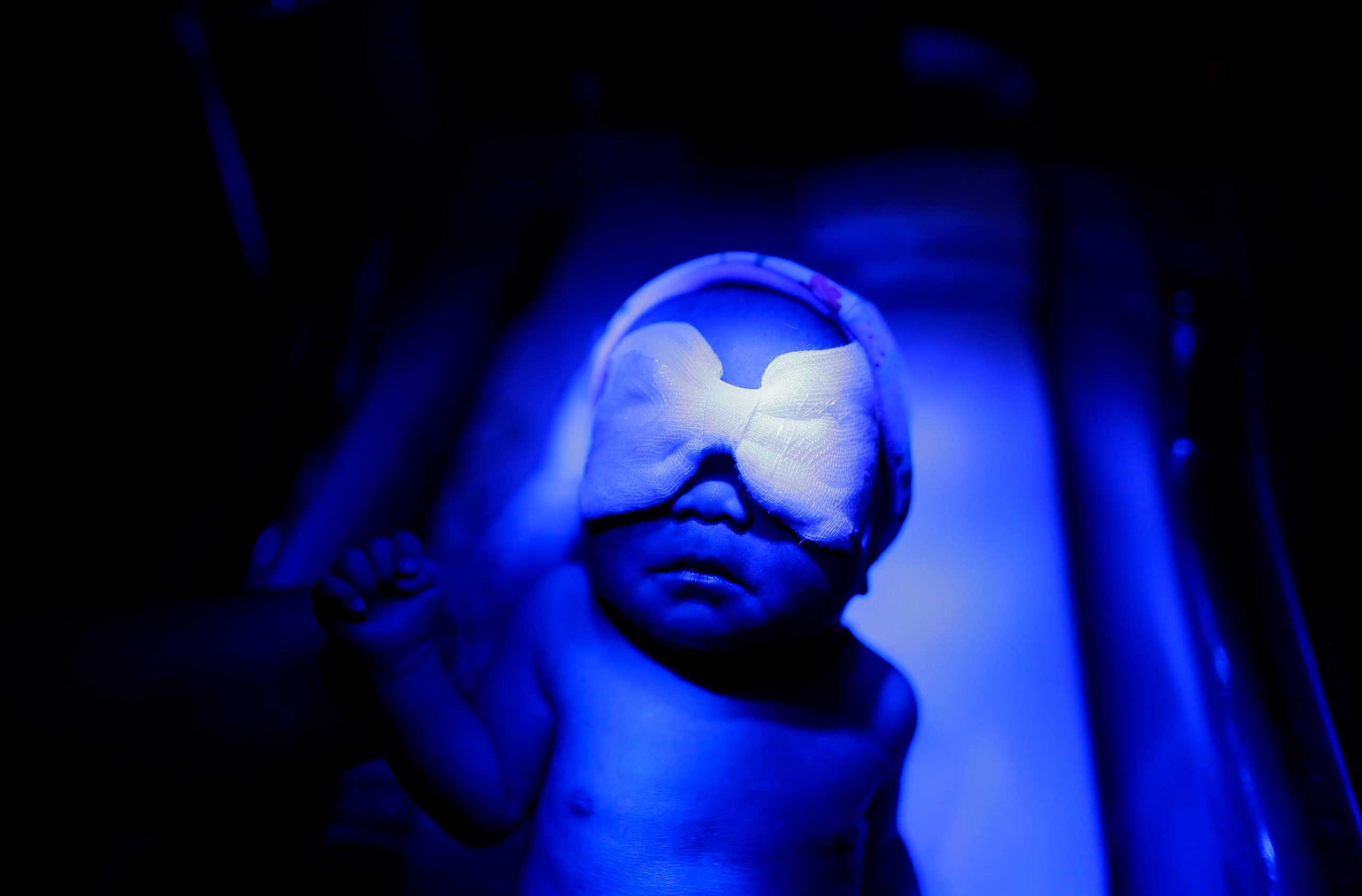 Nov. 6, 2014. Newborn Nisso Rada during a phototherapy session at the Neonatal Intensive Care Unit in the Eastern Visayas Regional Medical Center, which was damaged by the 2013 Typhoon Haiyan in Tacloban City, Leyte province, Philippines,