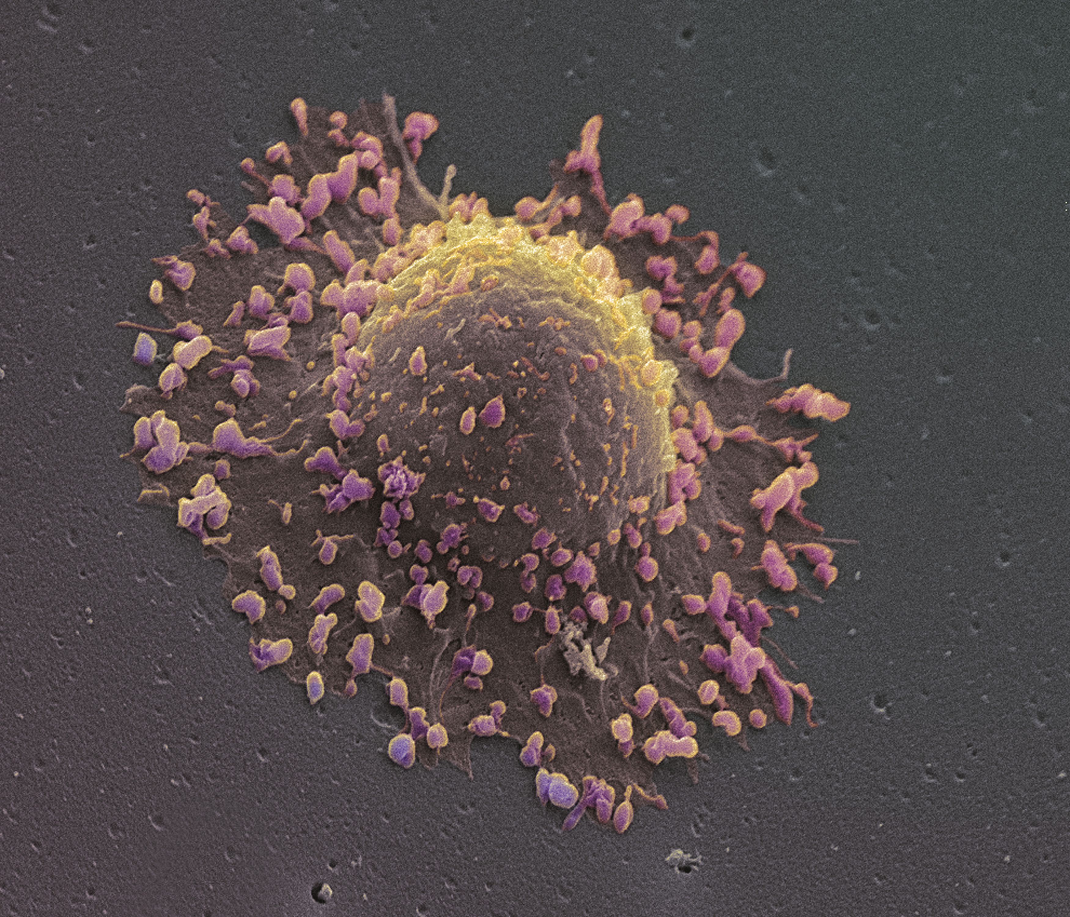 Lung cancer cell (STEVE GSCHMEISSNER&mdash;Getty Images/Science Photo Library RM)