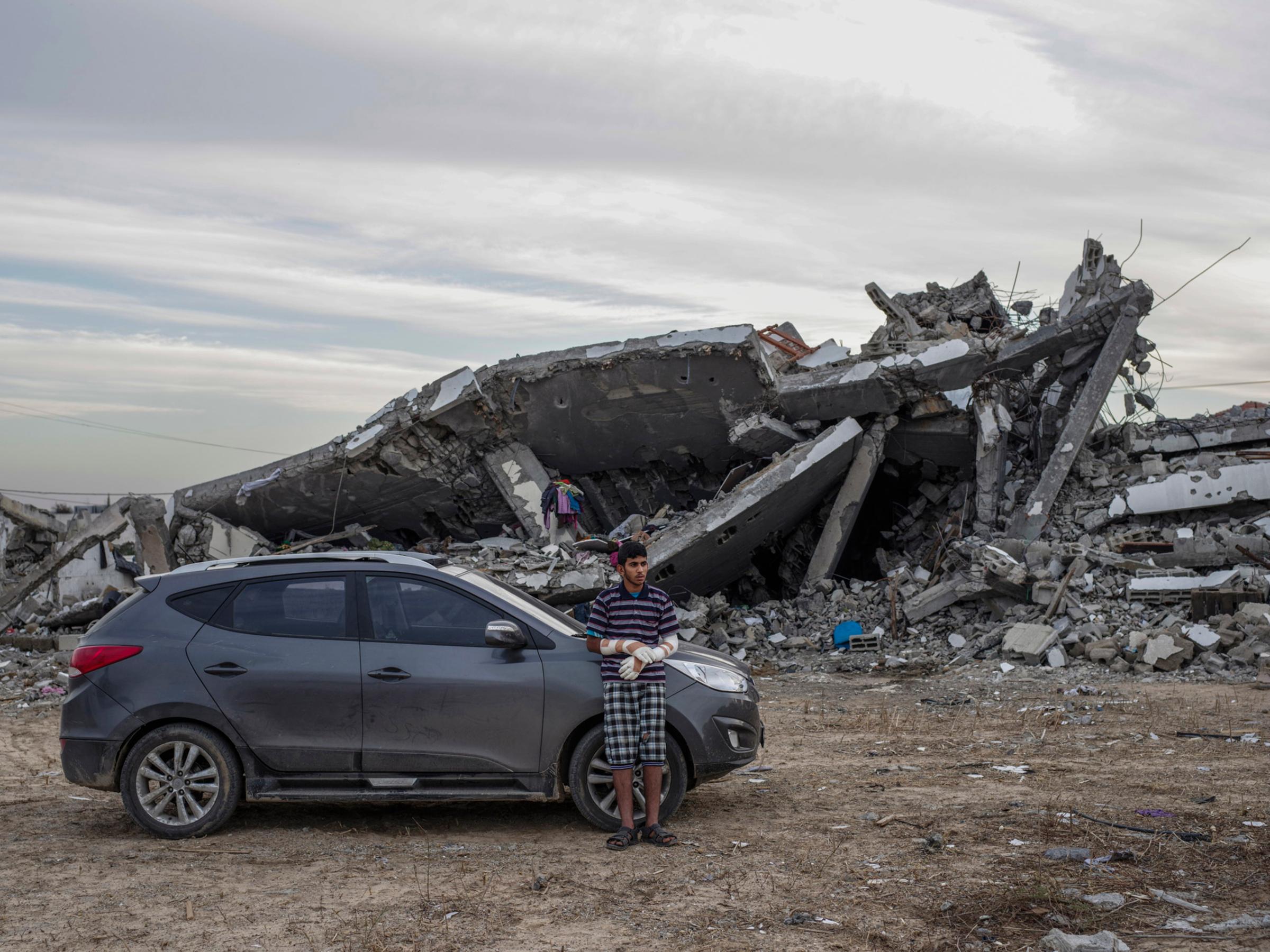 2014.  Gaza.  Palestine. Motaz Abu Aser, who badly injured both hands in an airstrike in the destroyed Shujai'iya neighborhood.  Operation Protective Edge lasted from 8 July 2014 – 26 August 2014, killing 2,189 Palestinians of which 1,486 are believed to be civilians. 66 Israeli soldiers and 6 civilians were killed.  It's estimated that 4,564 rockets were fired at Israel by Palestinian militants.