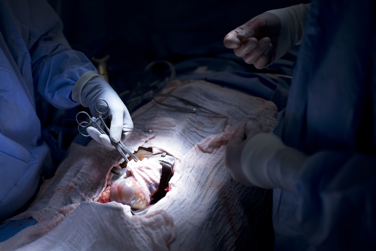 Dr. Niraj Desai (L) places a kidney into