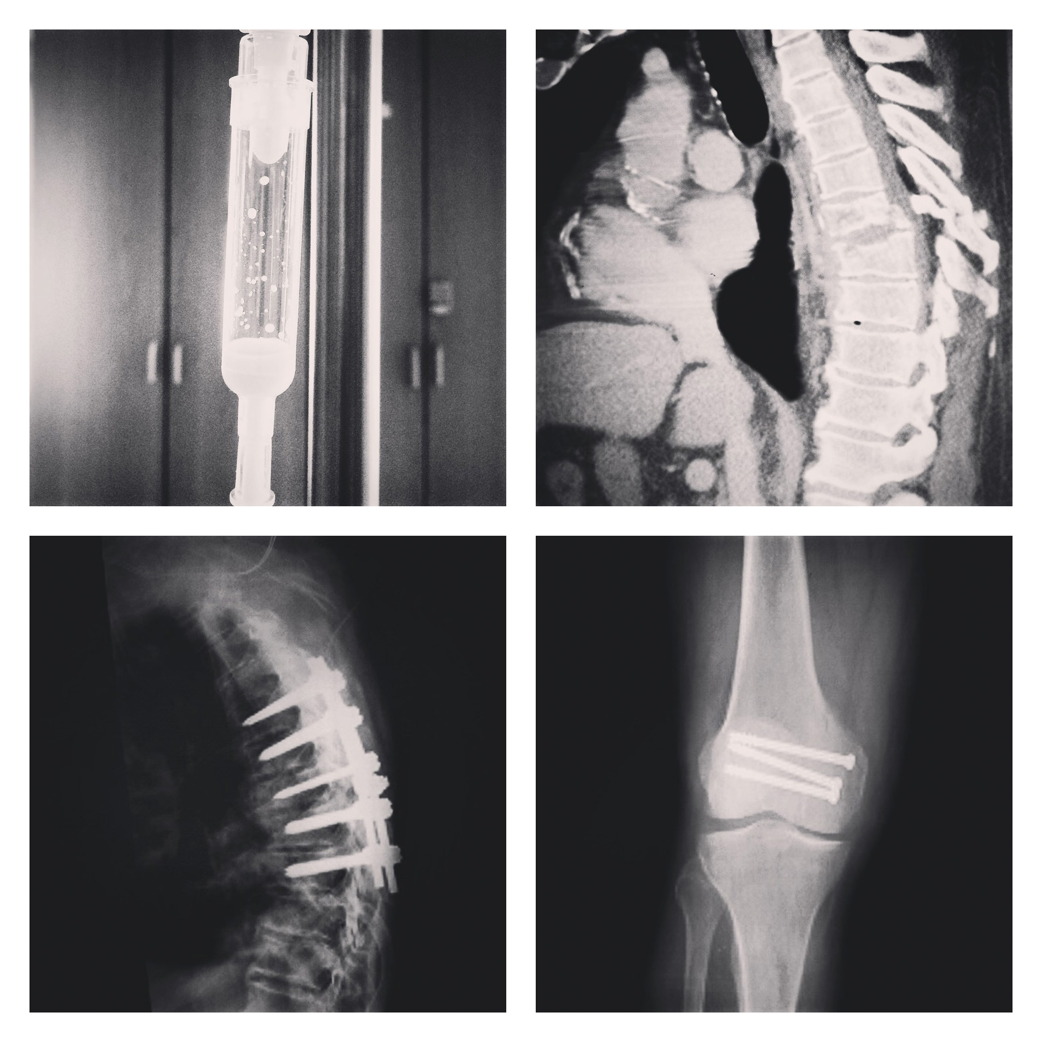 Food Drip; Fractured and Separated Spine; Spine With Pins; Screws