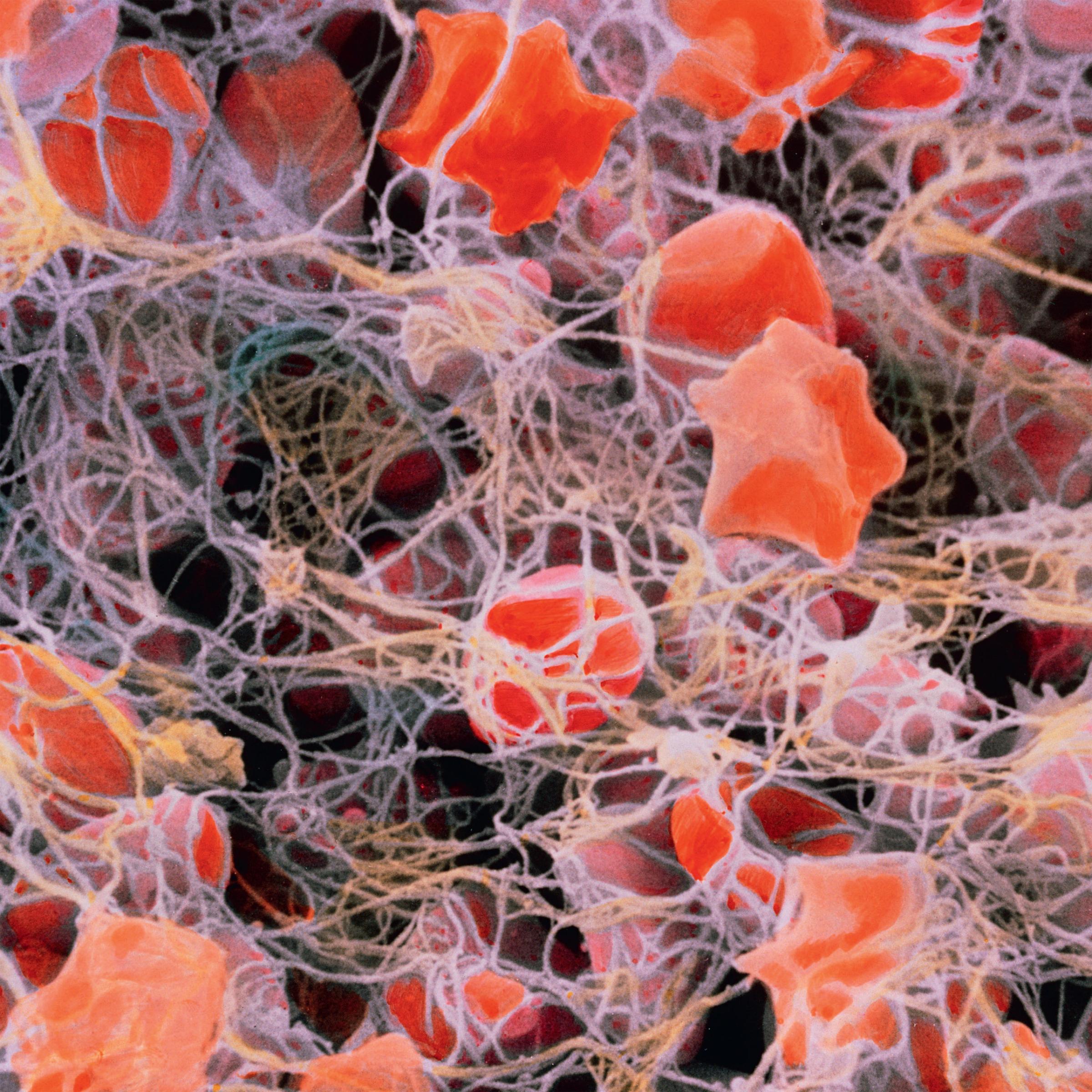 Blood clot (coloured scanning electron micrograph)