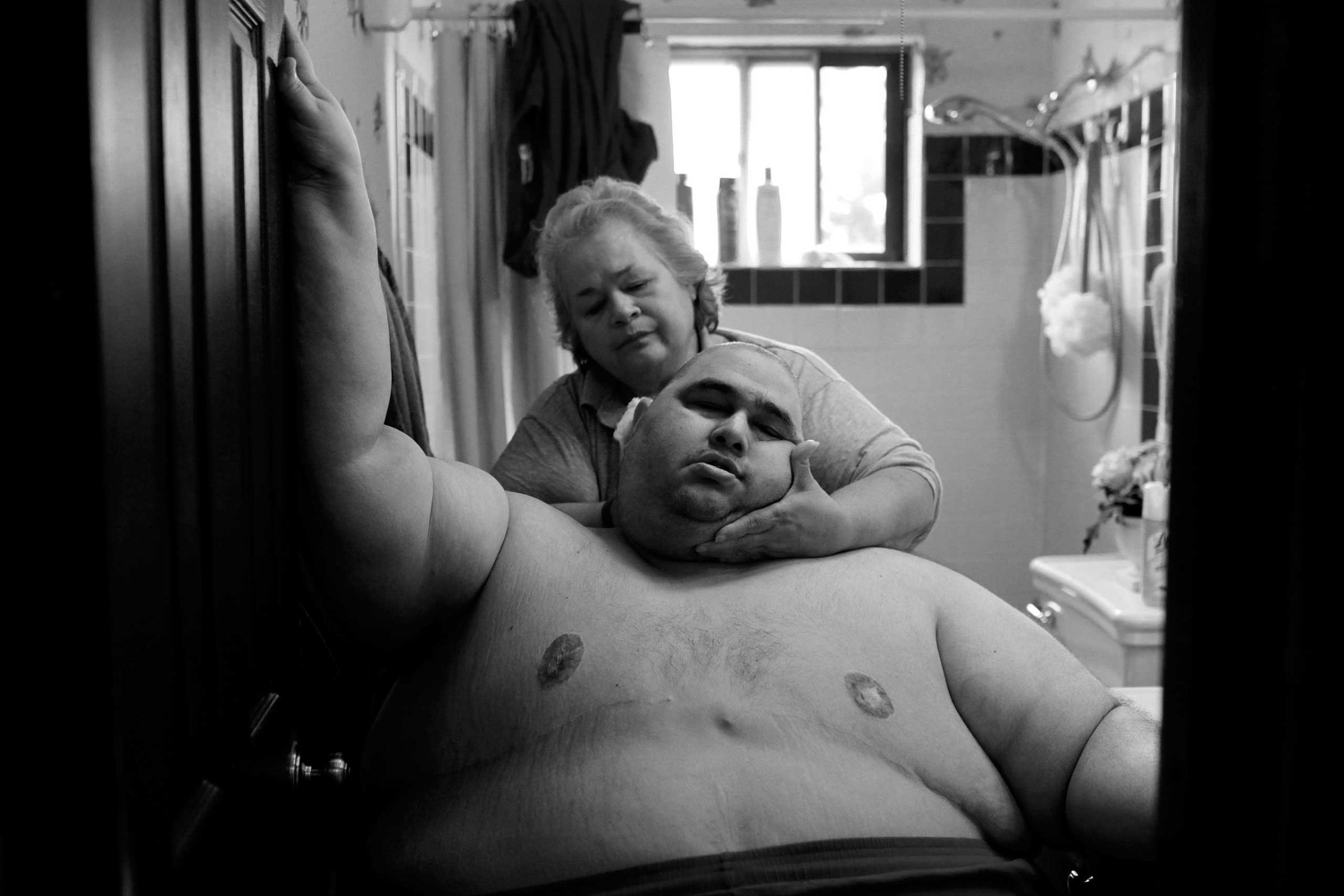 A Life Apart: The Toll of Obesity