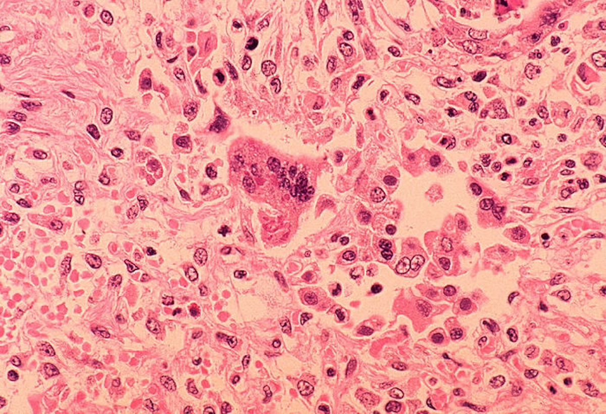 In this handout from the Centers for Disease Control and Prevention (CDC), a histopathology of measles pneumonia is seen in this microscope image from 1972 (Handout / Getty Images)