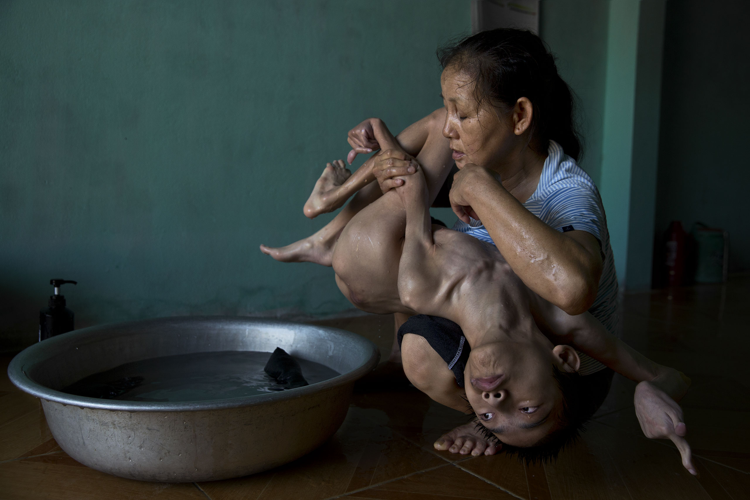 Tran Thien Nhan is bathed by his mother. Doctors believe his developmental deformities are due to his father's exposure to dioxins used in the Vietnam War.From  Vietnam Looks Forward.  April 20, 2015 TIME International issue.